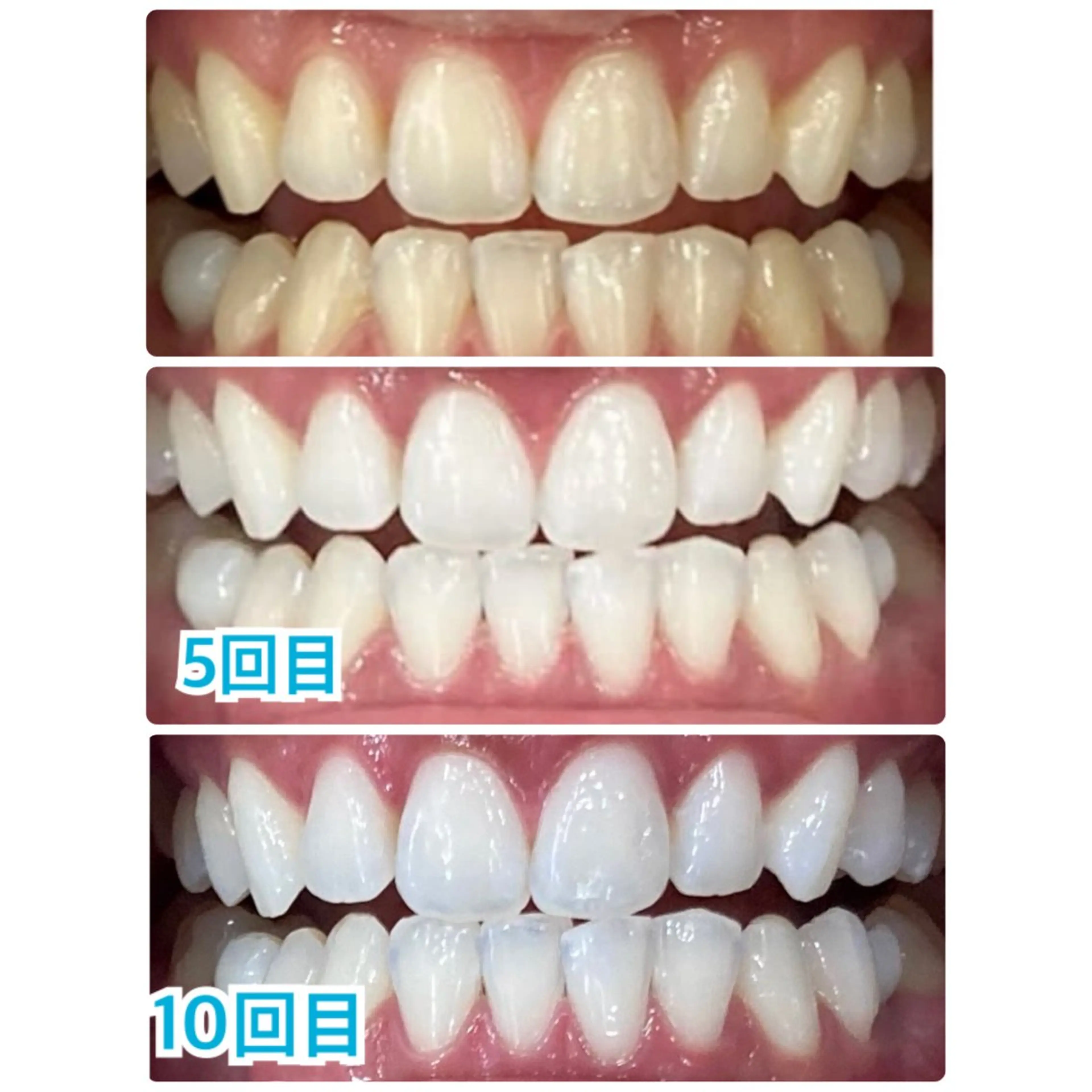 メンズ キッズ マツエク・マツパ プラチナムビューティー柏所属・【歯科提携】柏ホワイ トニングスタイルのその他イメージ