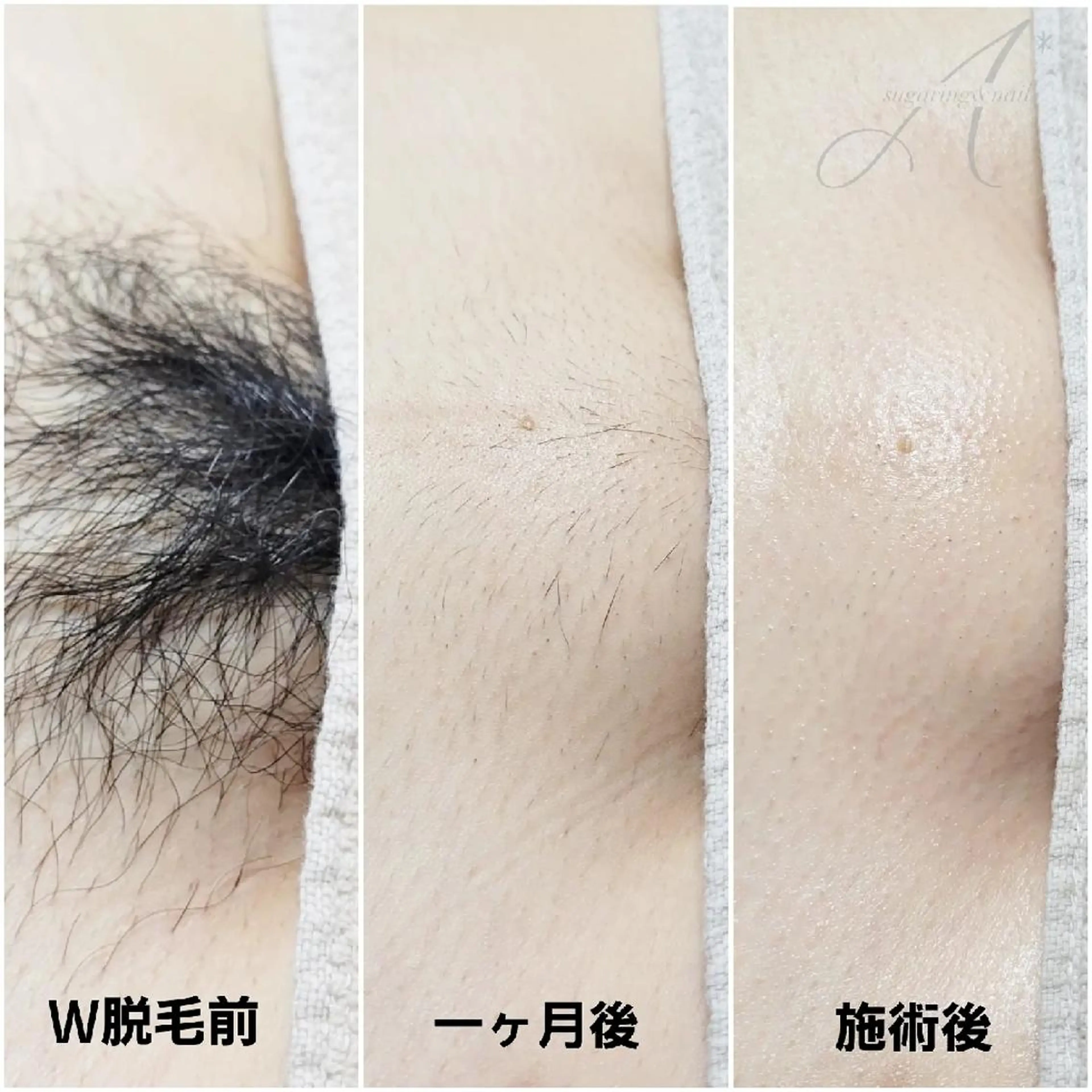 【1番人気🌟】VIOダブル脱毛🍋シュガーリング×最新光脱毛の写真