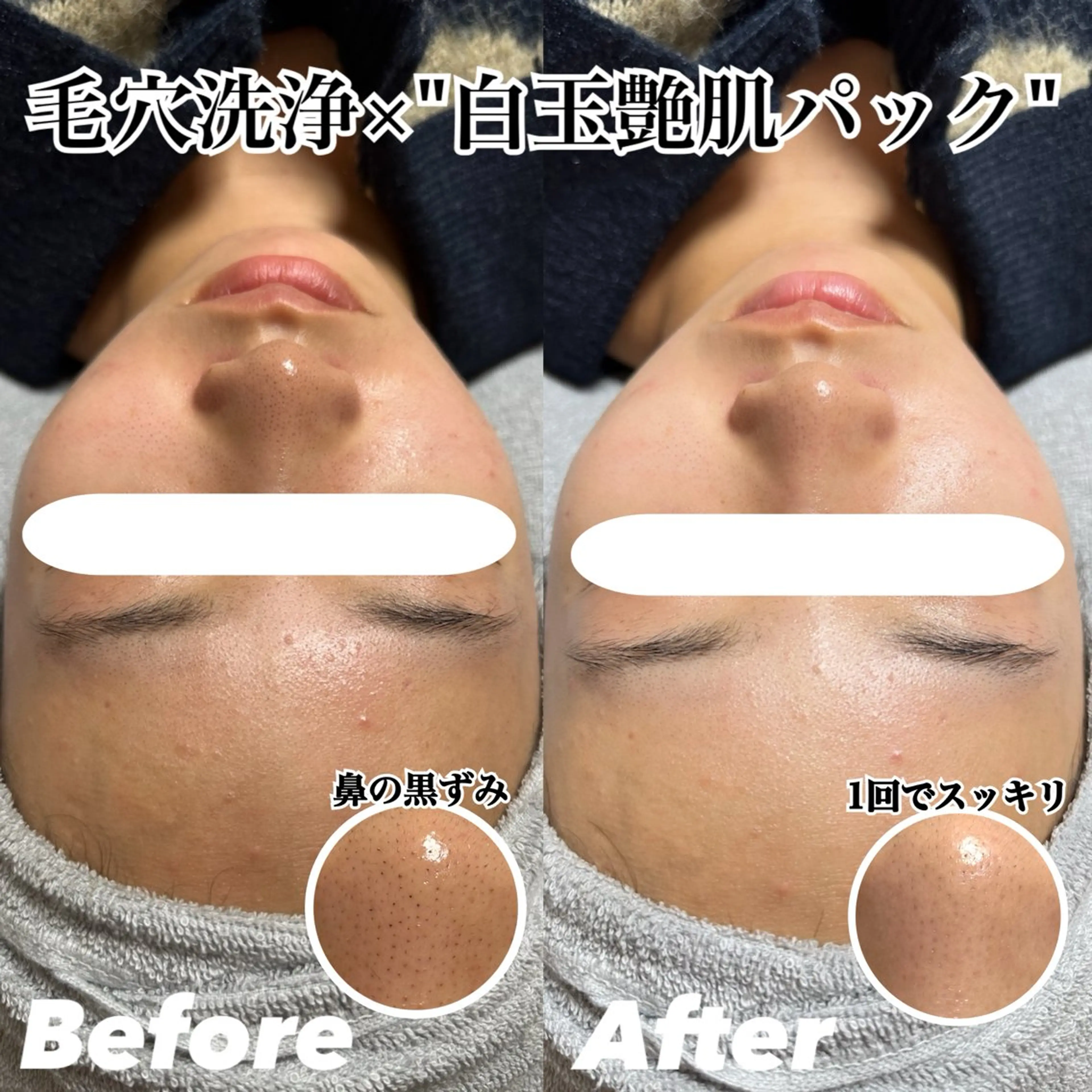 毛穴洗浄♢ハイドロフェイシャル【白玉艶肌パック仕上げ/美白】(顔・首)の写真