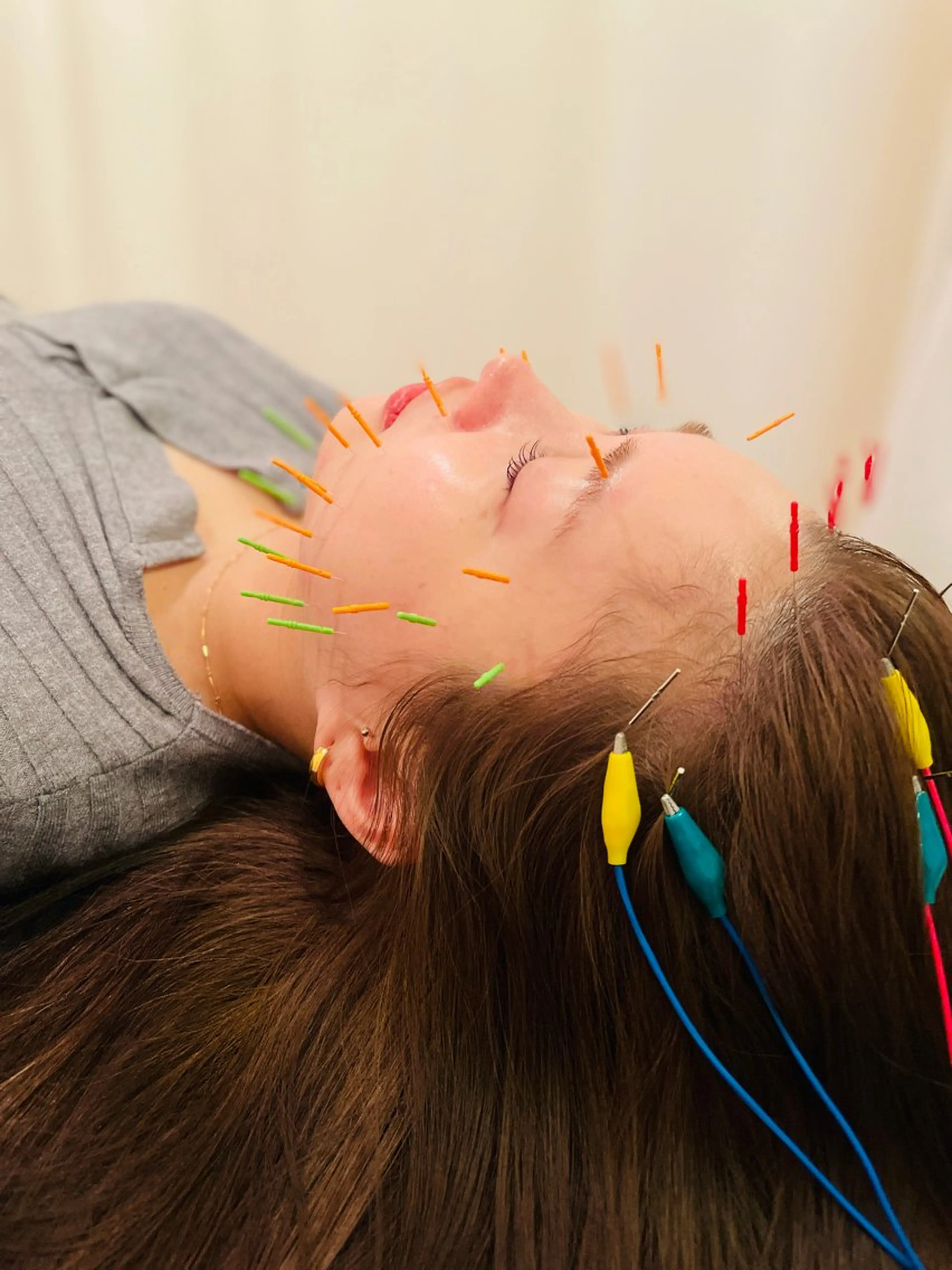 【40本使用】美容鍼(電気有⚡️)スタンダードコースの写真