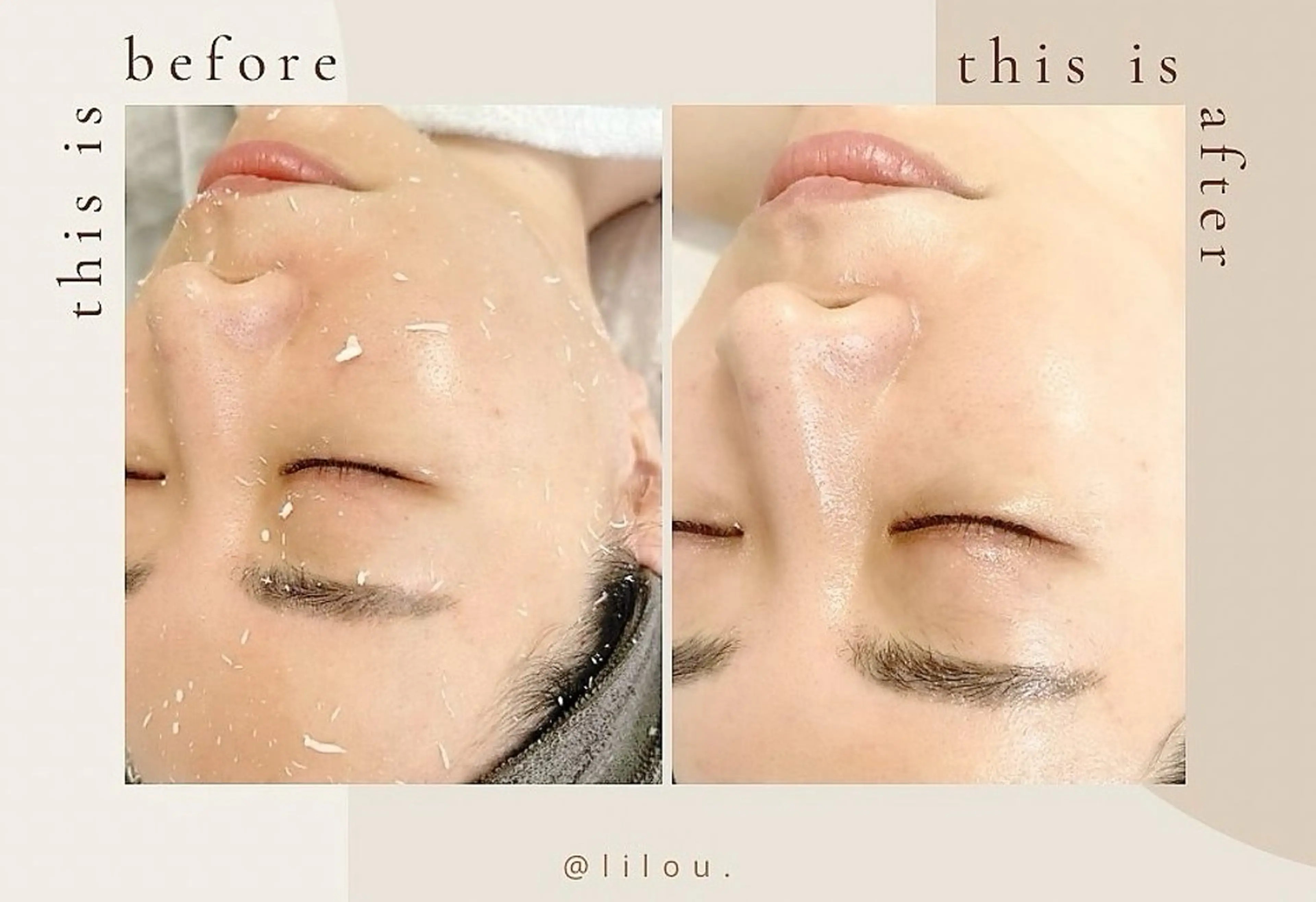 人気No.1🎖️✨韓国艶肌🇰🇷毛穴撲滅‼️肌のキメを整えるピーリング🫧の写真