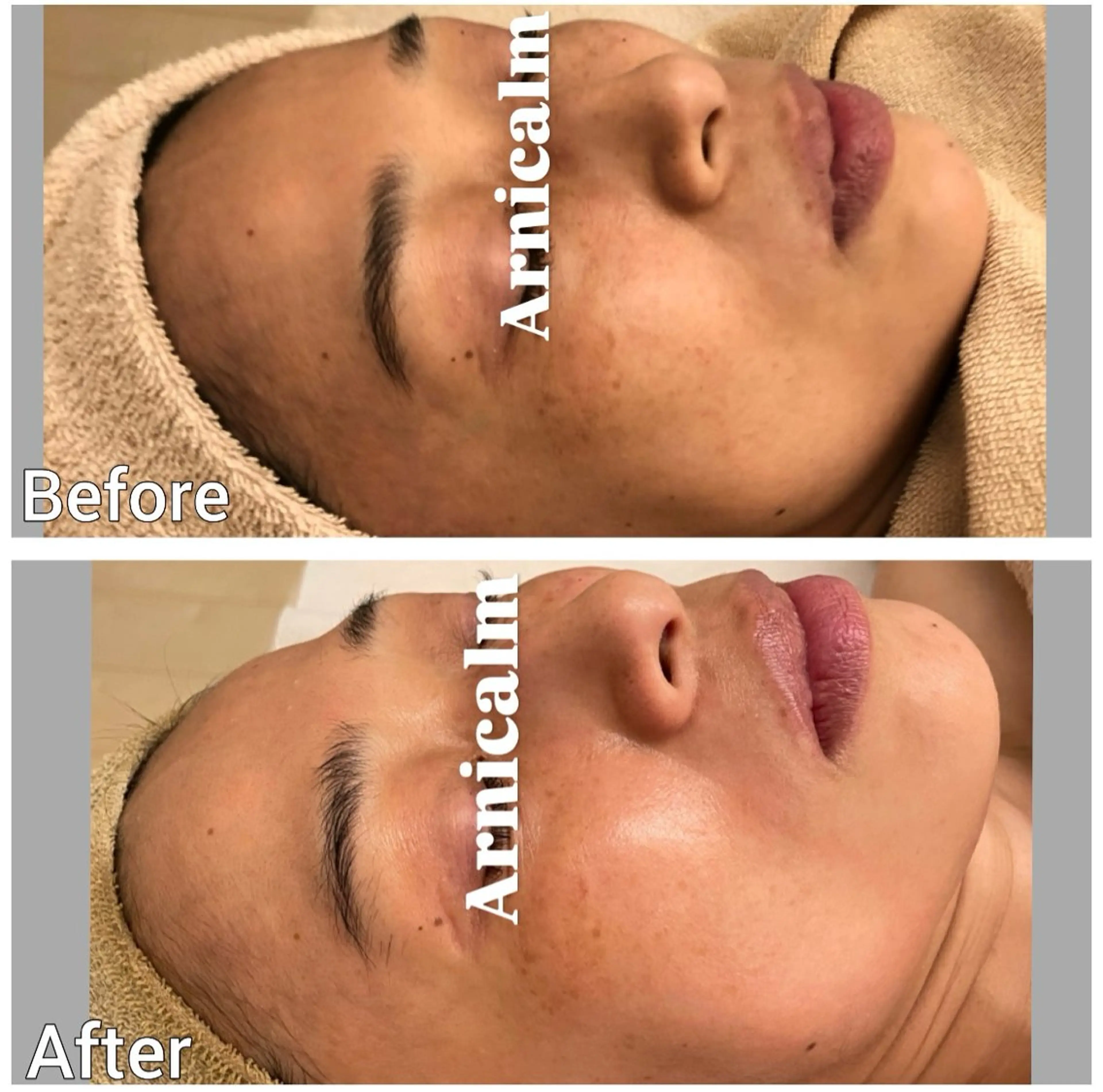 エステ ハーブピーリング 肌再生ピーリング/のエステ・リラクイメージ