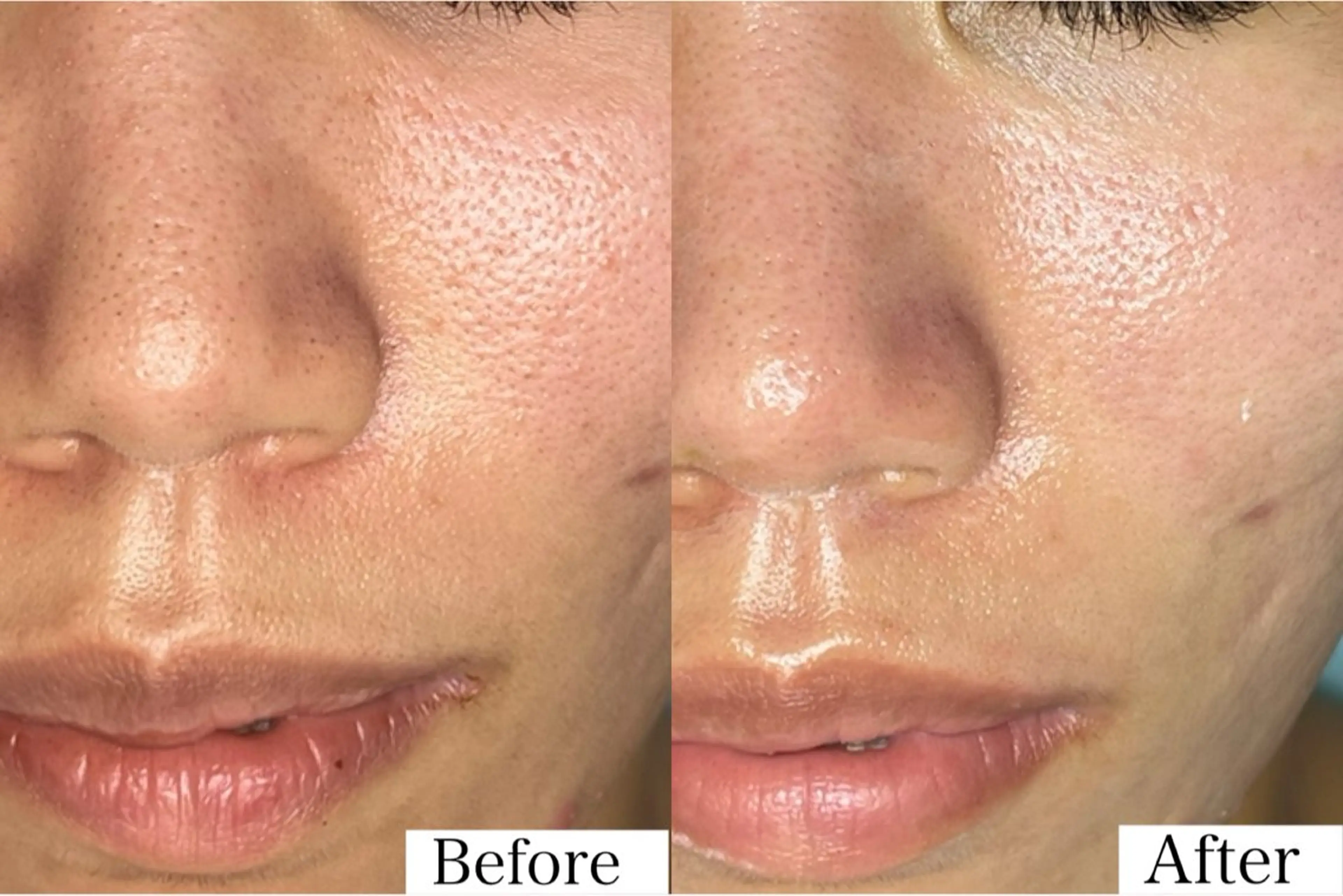 毛穴開いてませんか？とにかく毛穴に悩みをお持ちの方限定！肌診断・ハーブピーリング90分の写真