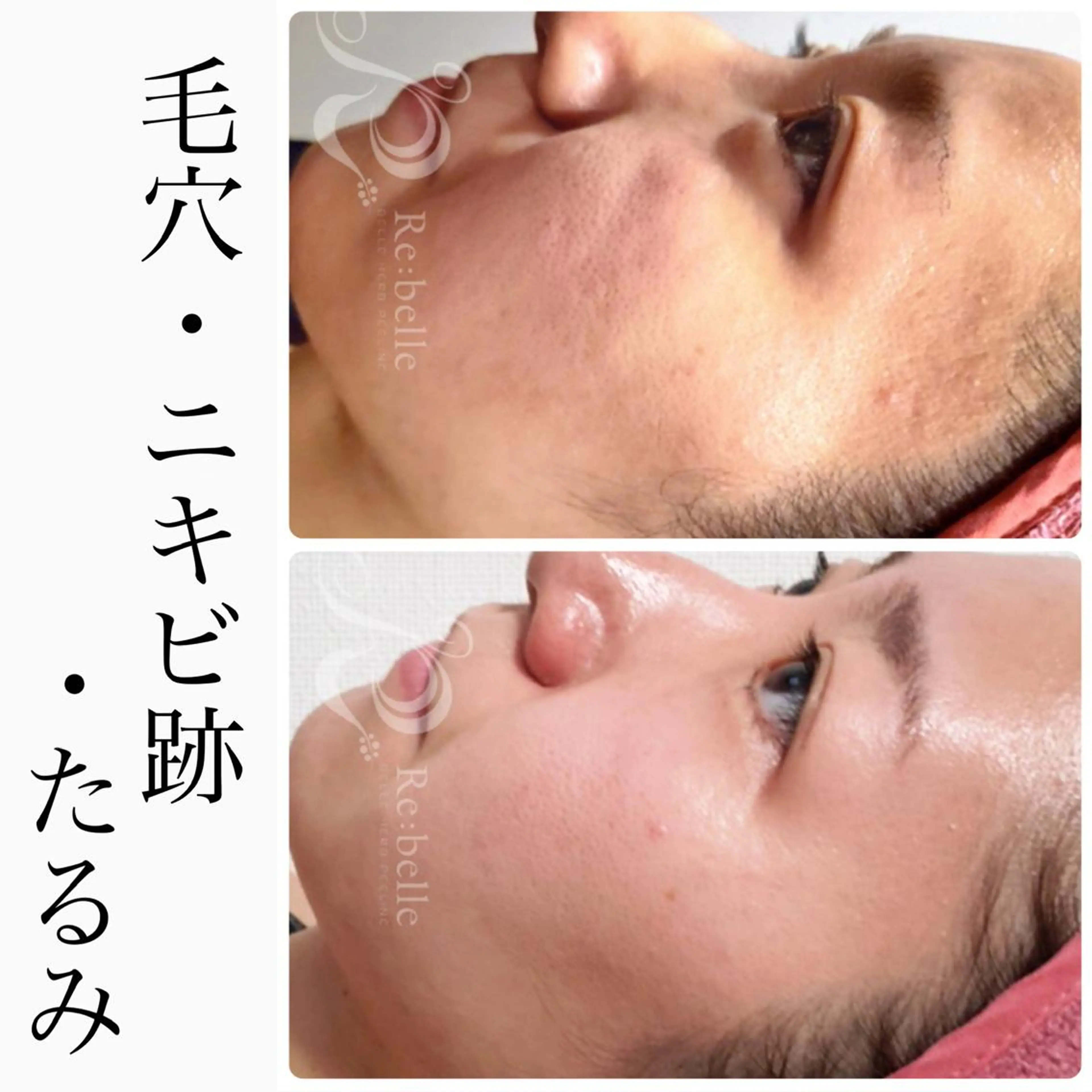 エステ BeSkin藤沢店所属・ニキビ/肌質改善 BeSkin 藤沢店のエステ・リラクイメージ