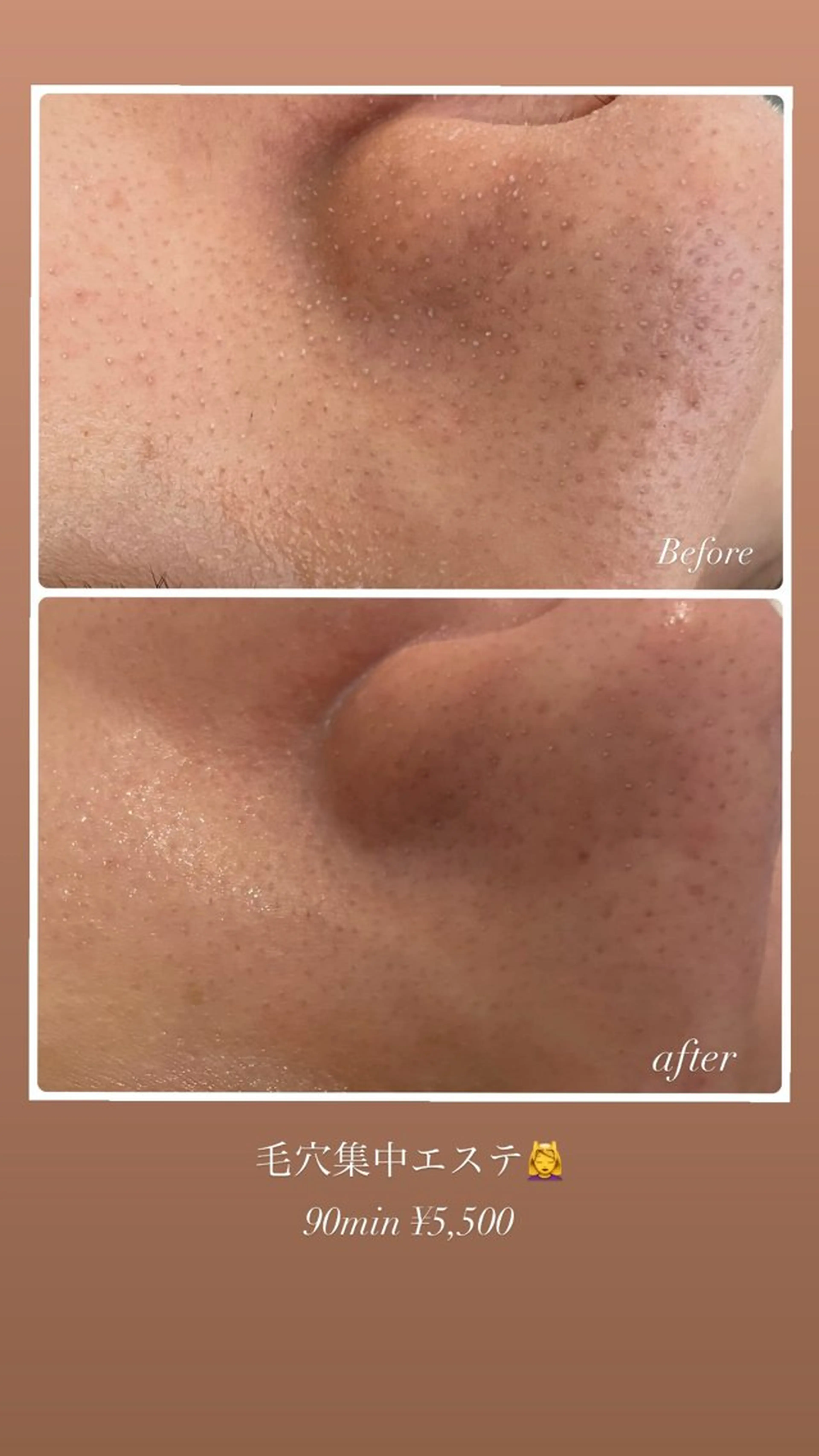 毛穴クリアフェイシャルトリートメントの写真