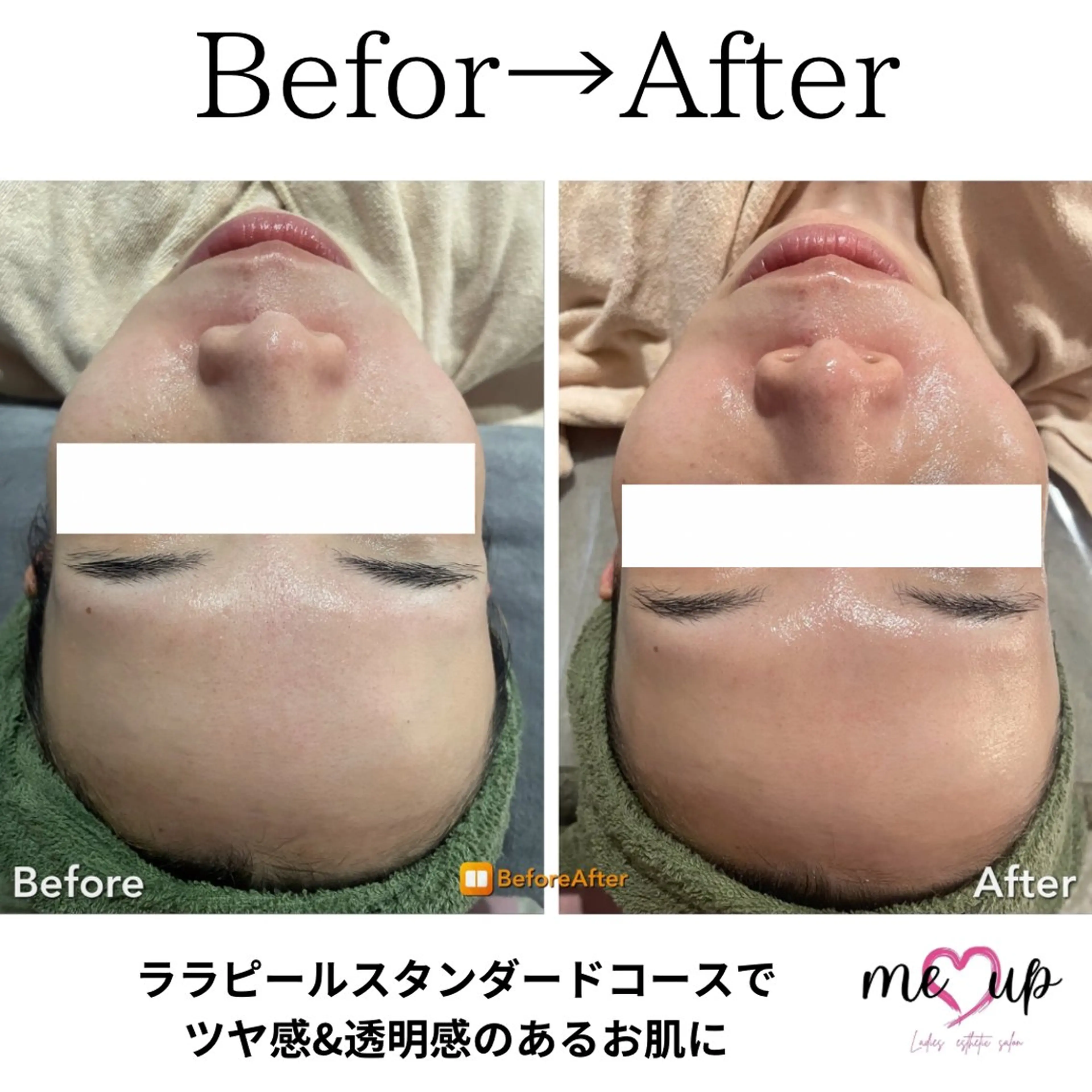 エステ Meupニキビ専門店 背中/ハーブ/肌管理のその他イメージ