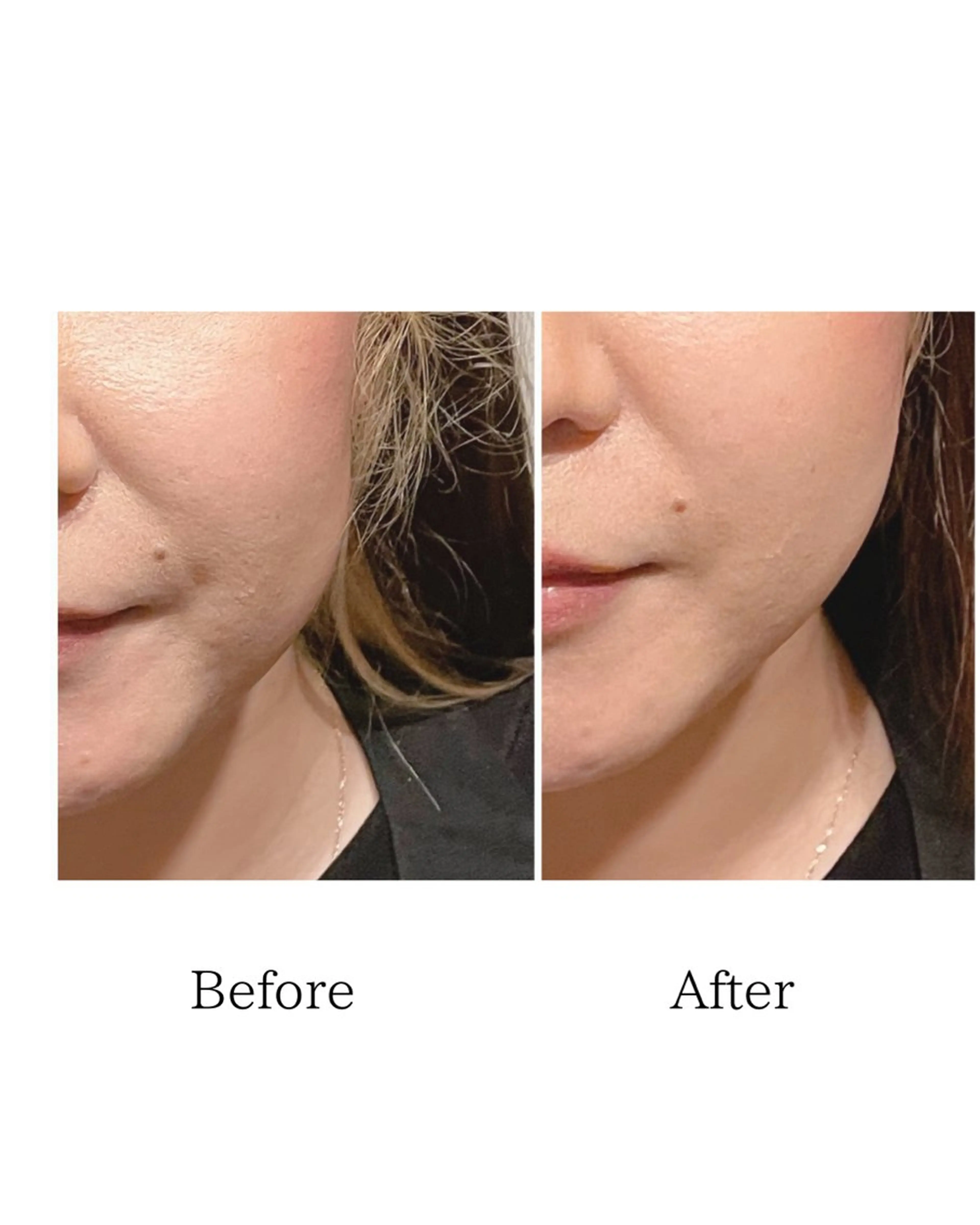 たるみを引き上げてフェイスラインがシャープに、眼精疲労もスッキリ【美容鍼灸+小顔矯正+肩甲骨はがし】の写真