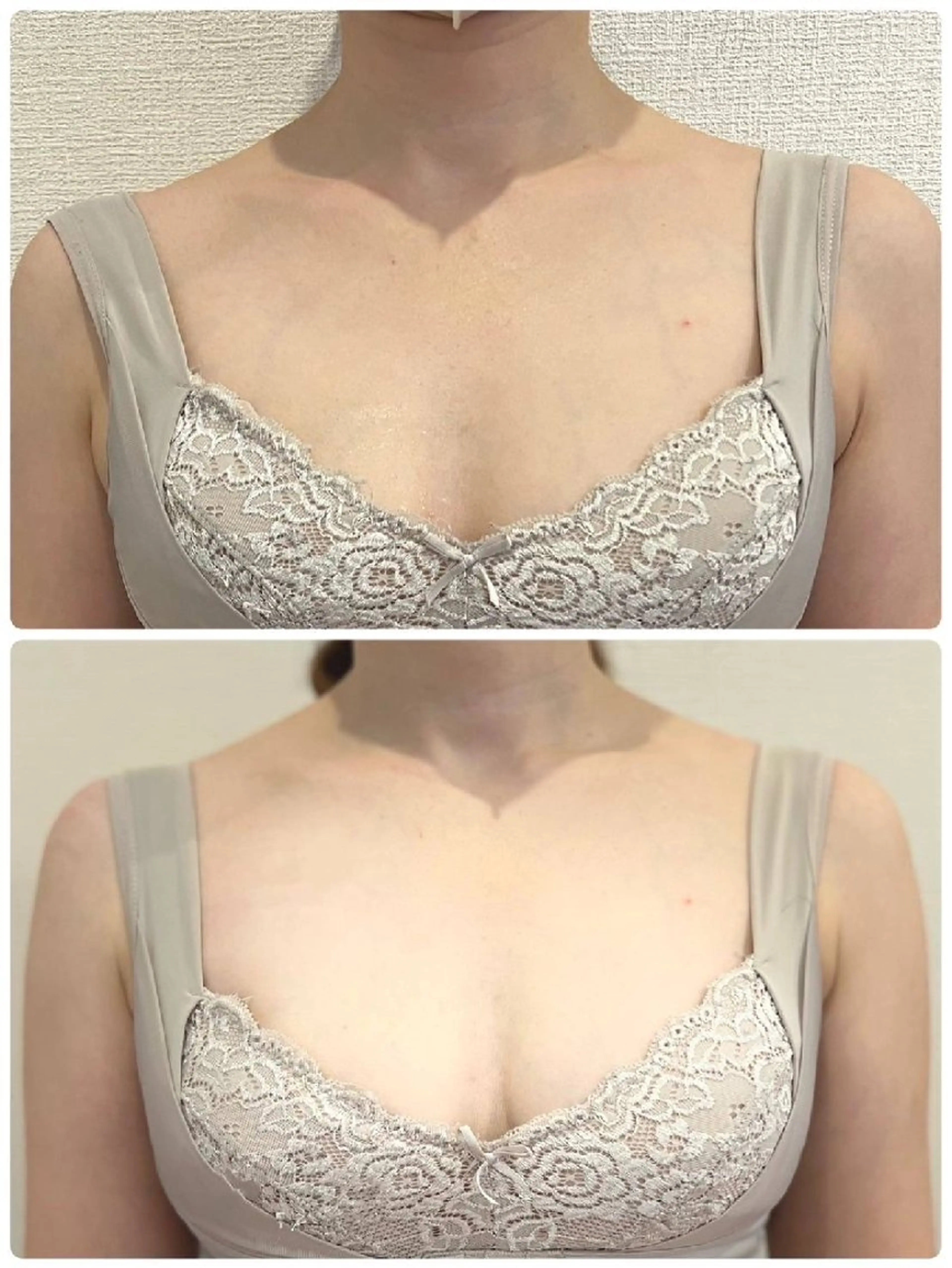 ☆追加オプション☆バストにダイレクトに届ける/濃密美容導入エレクトロポレーションの写真