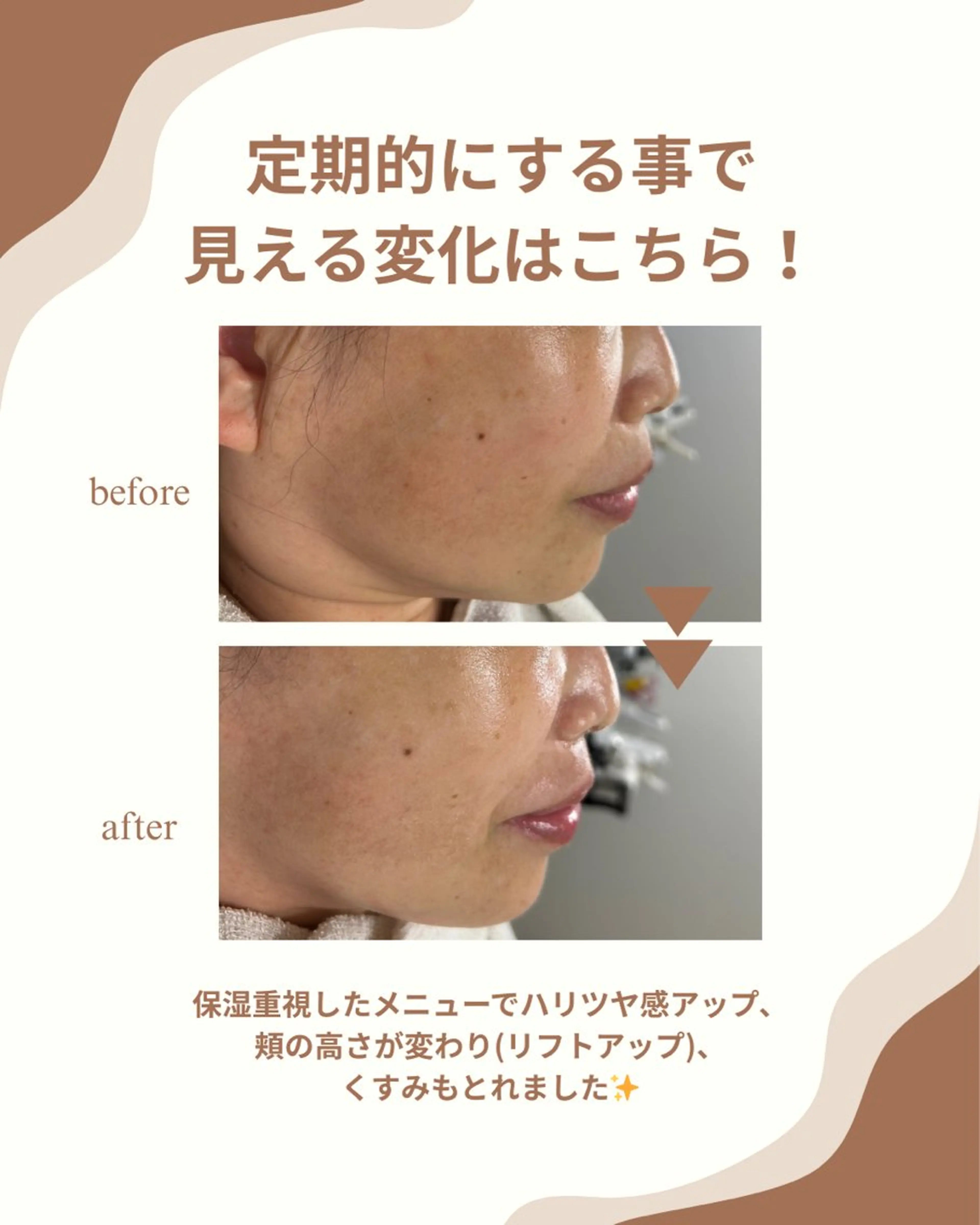 【人気No.2】くすみ、たるみ、乾燥、荒れやすいお肌に！✨美容最高級の石膏パックで潤いチャージの写真