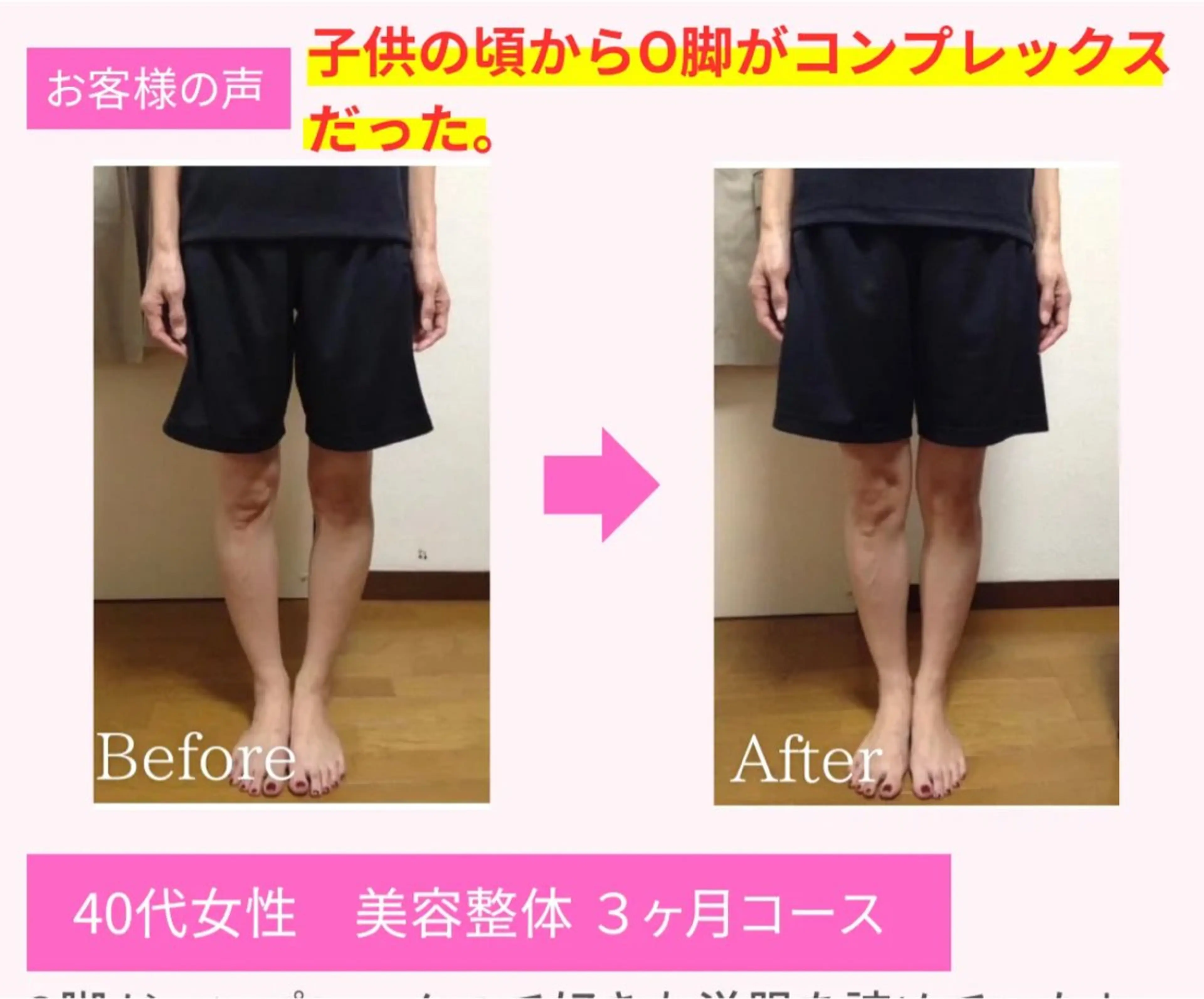 O脚・X脚矯正【脚の歪み・膝の隙間・脚のむくみ】細身のパンツが苦手な方への写真