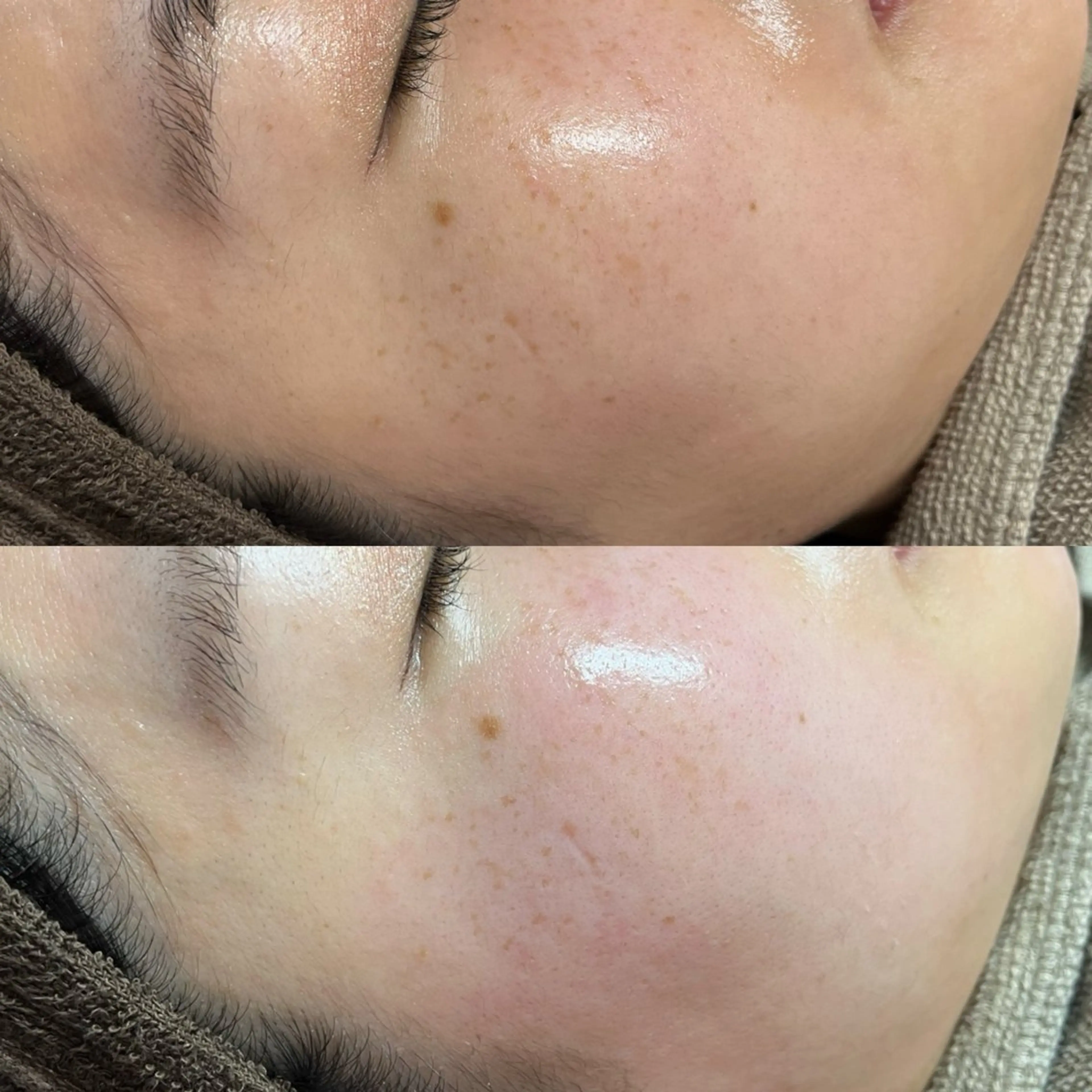 フェイシャルワックス全顔＋鎮静パック付の写真