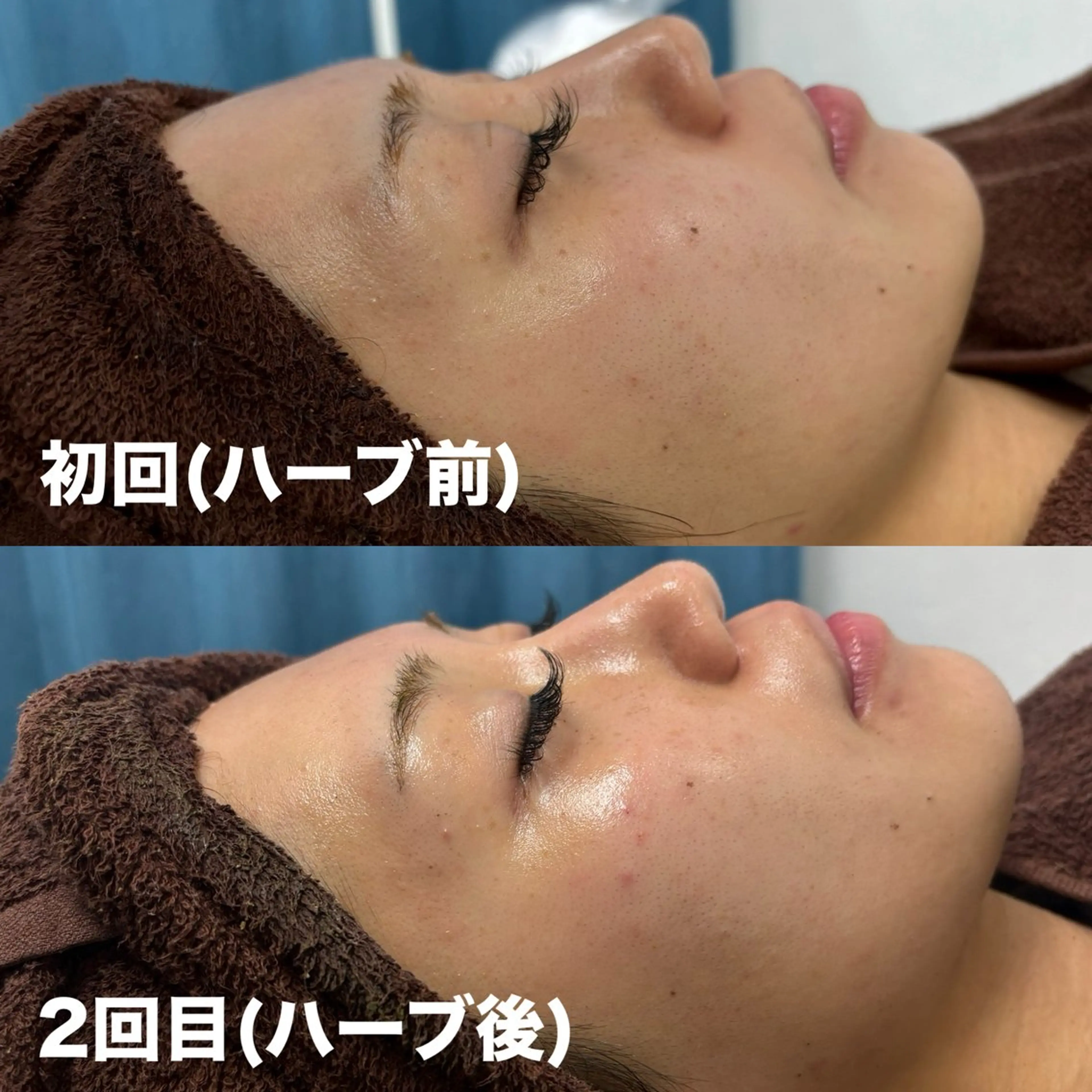 エステ 肌質改善 陶器肌🌿のエステ・リラクイメージ