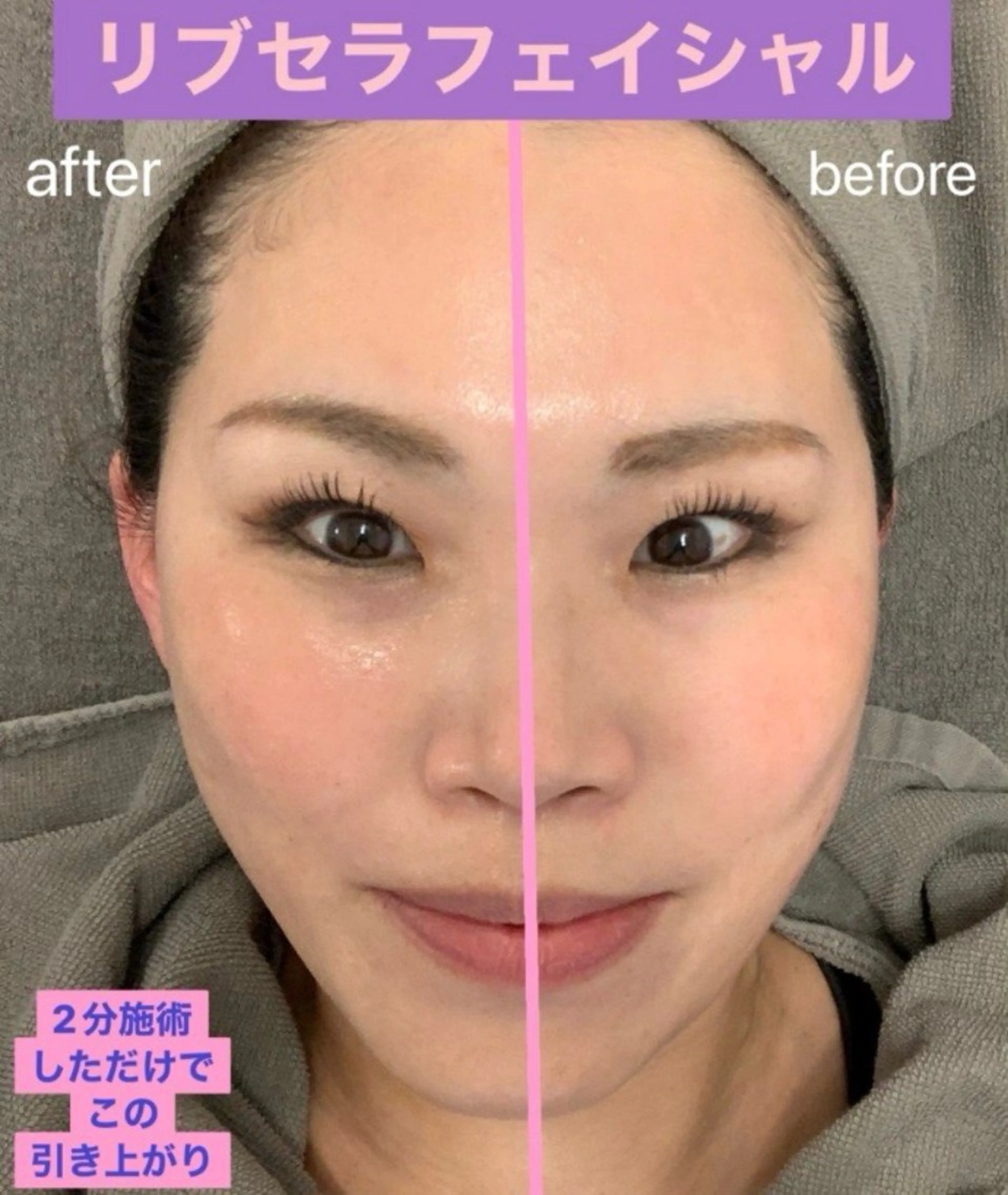 当店人気No. 1メニュー　整形級エステ　　　　　　　　　　　　　　　　✨リブセラフェイシャル✨の写真