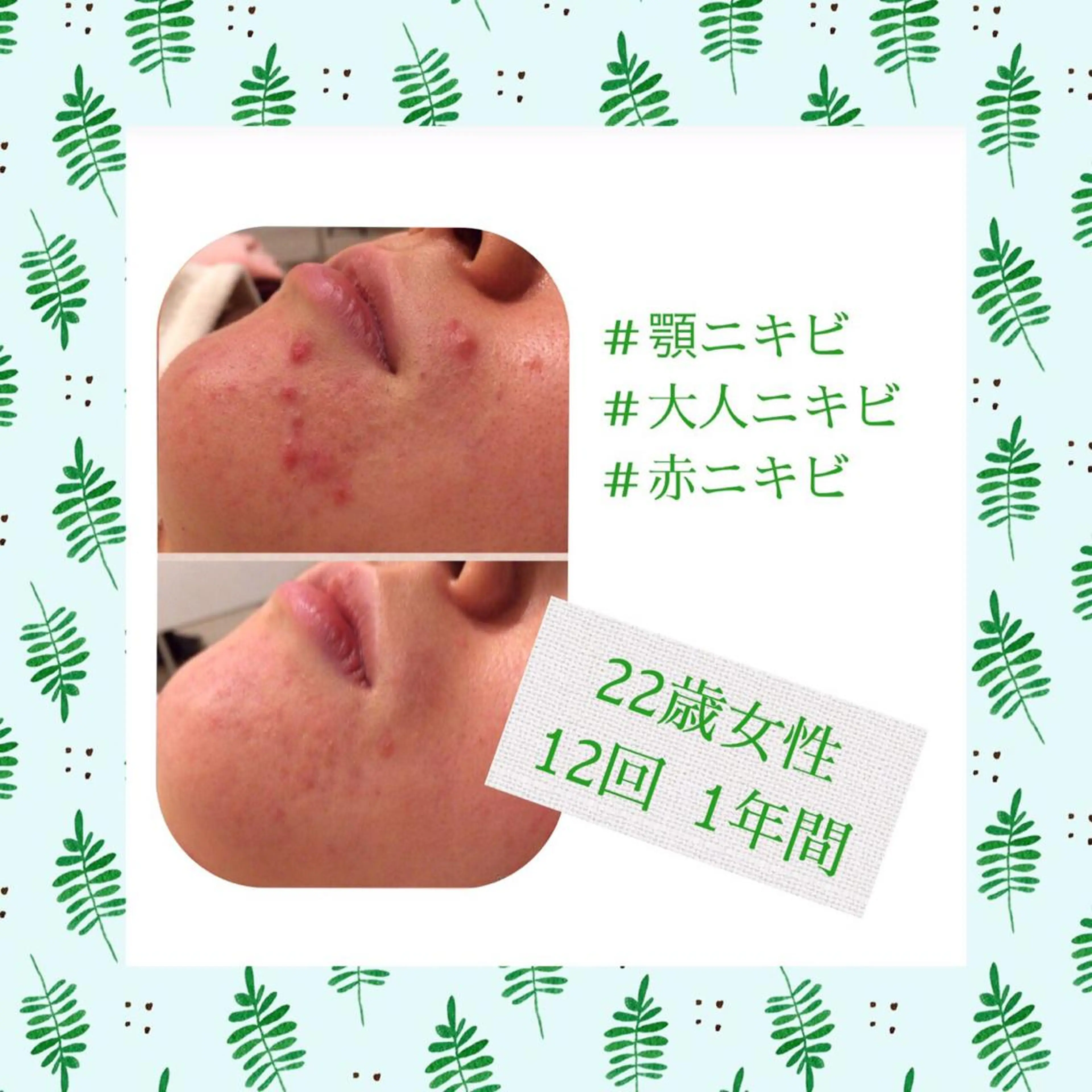 ミディアム カラー パーマ ヘアアレンジ メンズ キッズ ネイル マツエク・マツパ エステ リラク ニキビ・肌質改善専門 ♡人生が変わるサロンのエステ・リラクイメージ