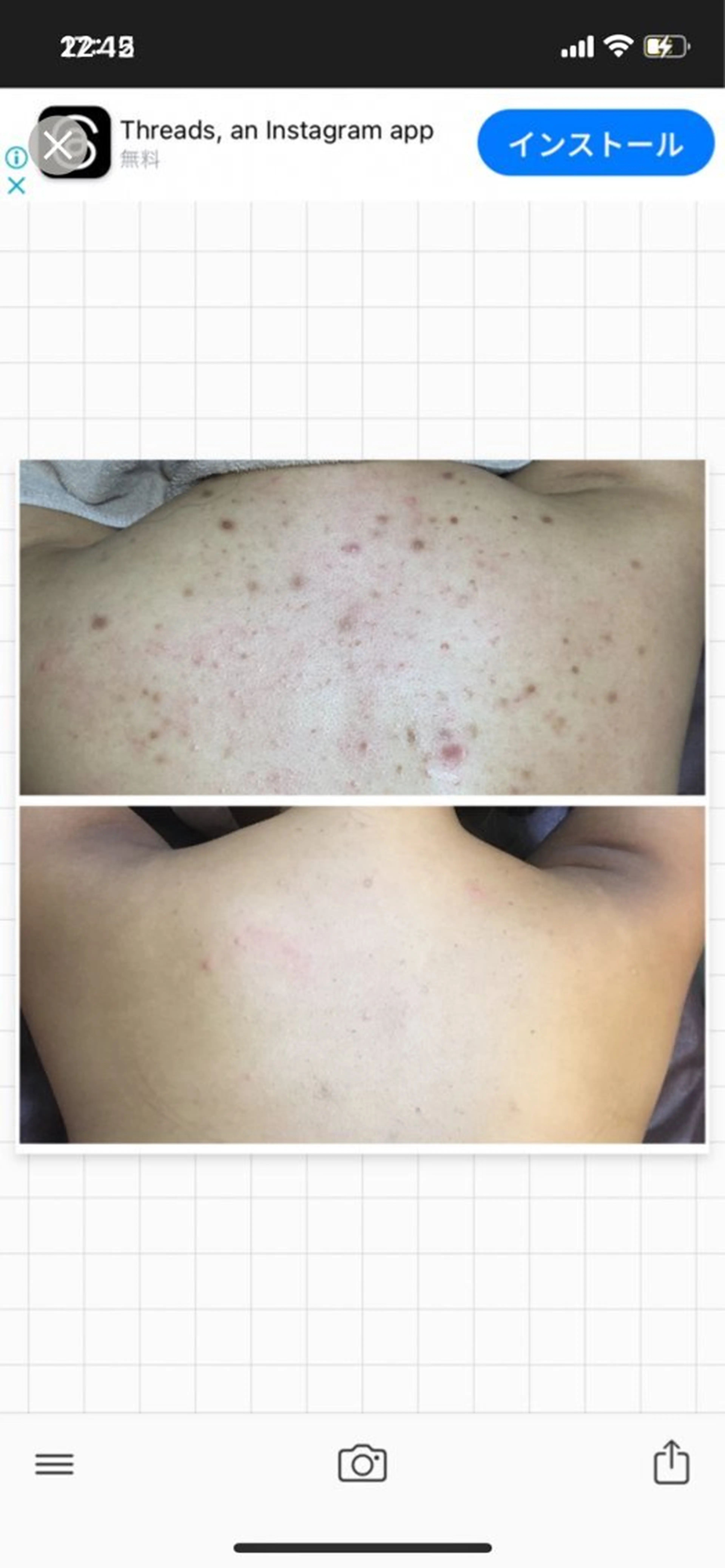 人気No.1👑ハイドラ（毛穴洗浄）＋🌿ハーブピーリング（剥離あり）🌿背中or腰or二の腕orお尻orデコルテなどの写真