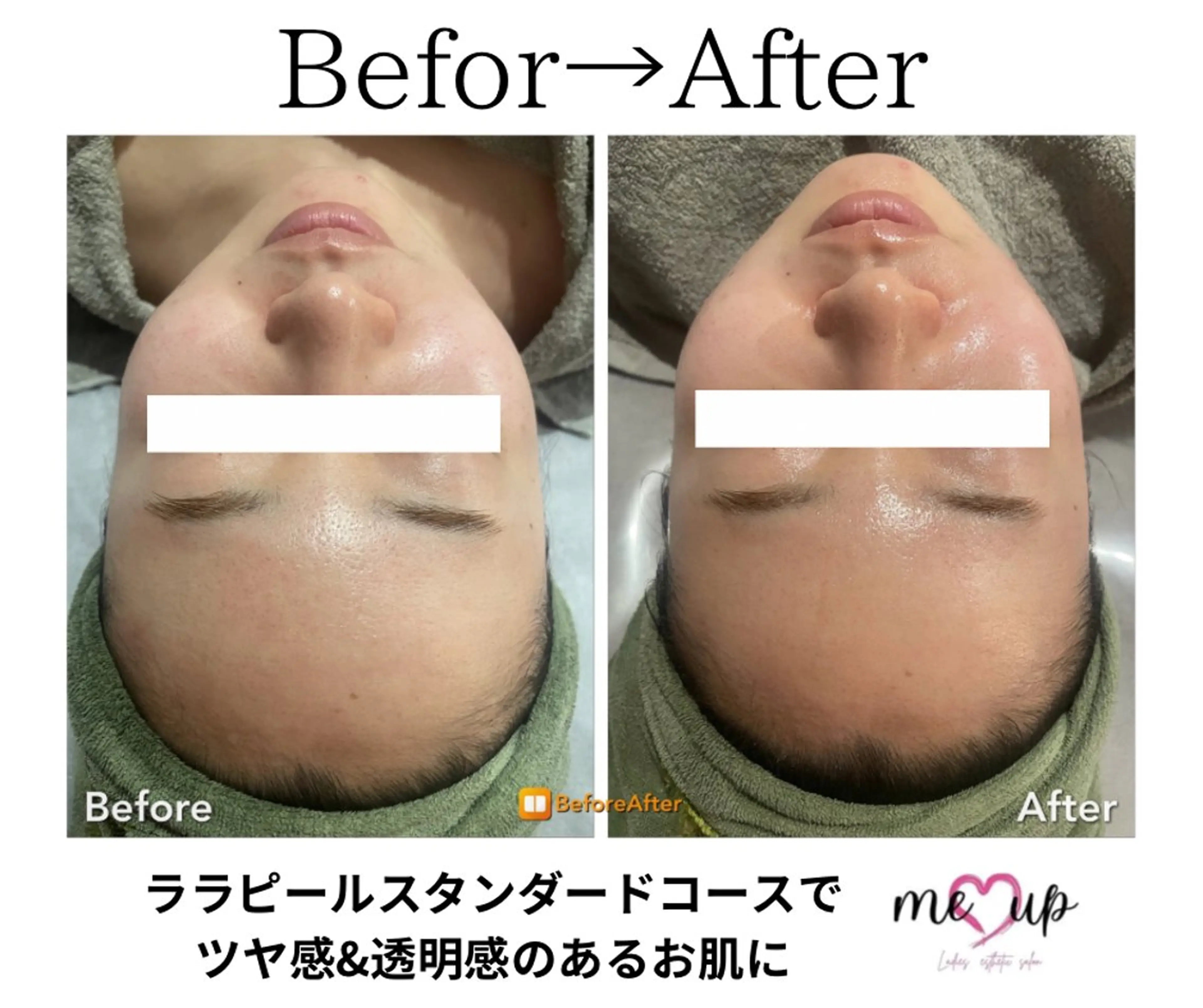 エステ Meupニキビ専門店 背中/ハーブ/肌管理のその他イメージ