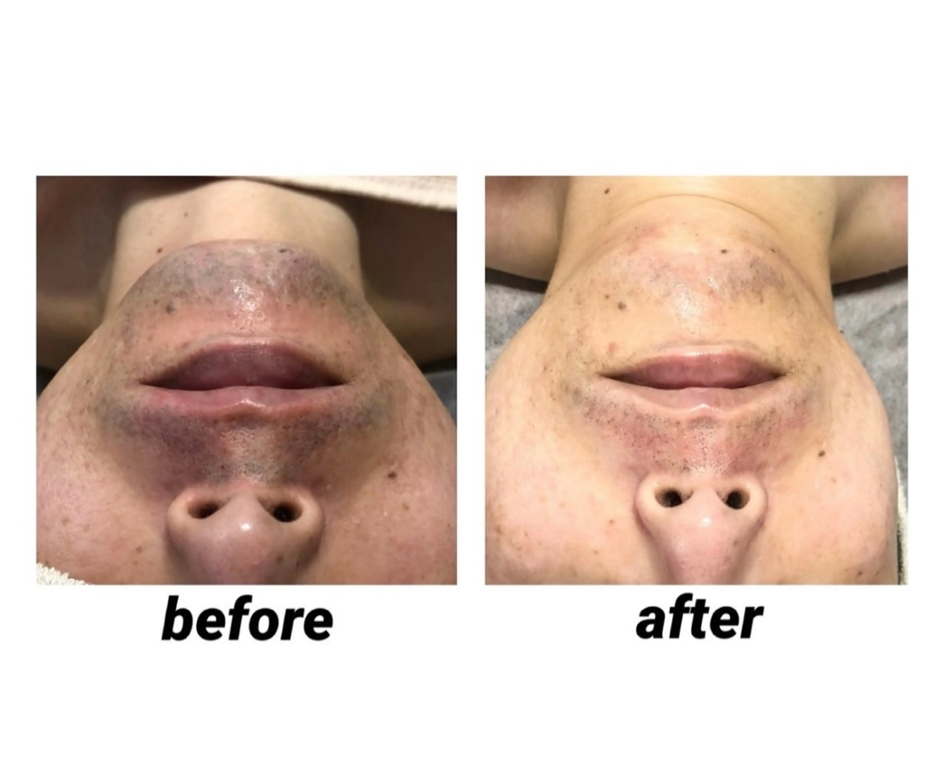 メンズ顔脱毛(ひげ)の写真