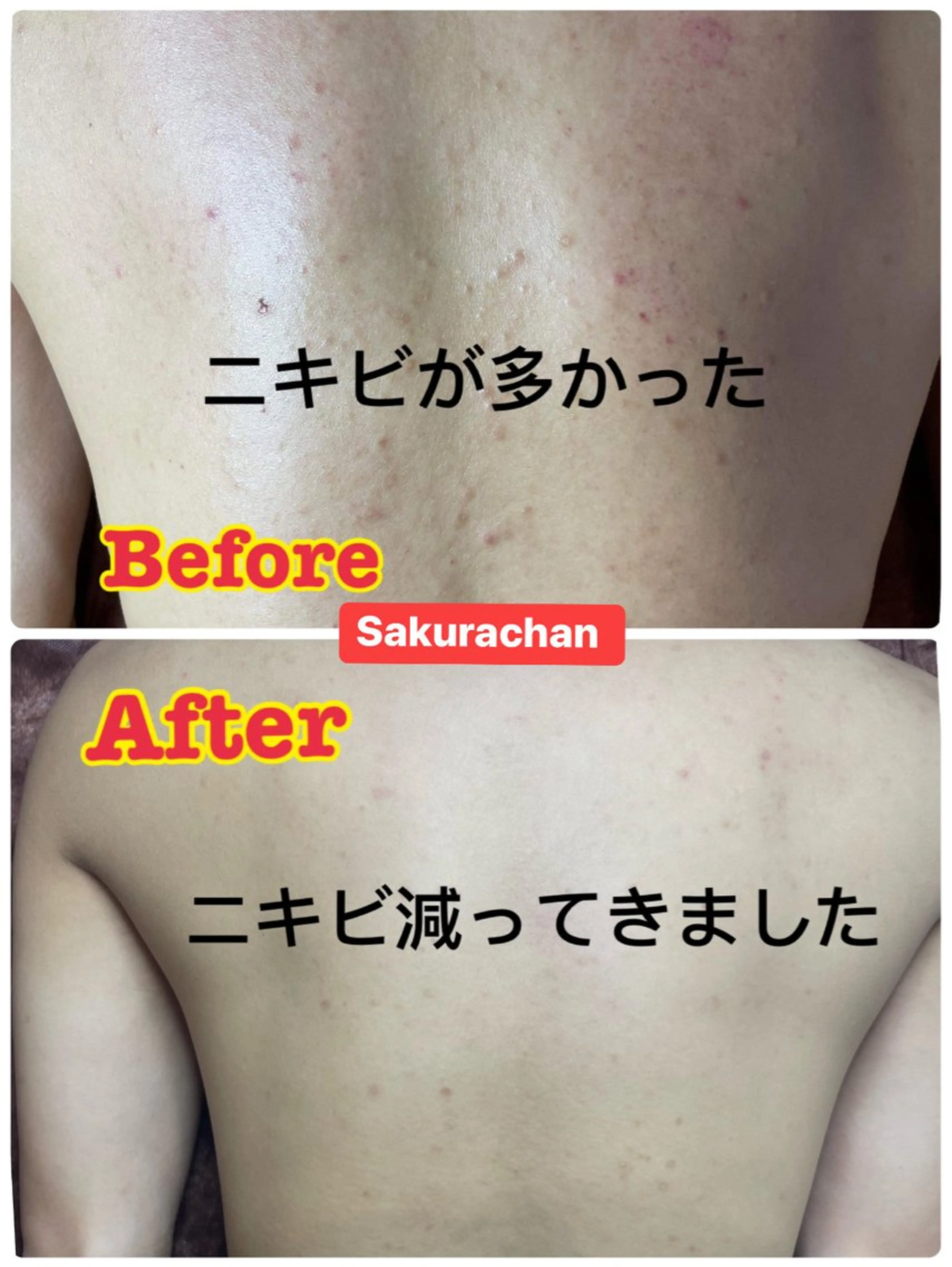 【🌸特別キャンペーン割引】『全背中大人ニキビ集中ケア】長年ニキビが悩んでいる方へおすすめコースの写真