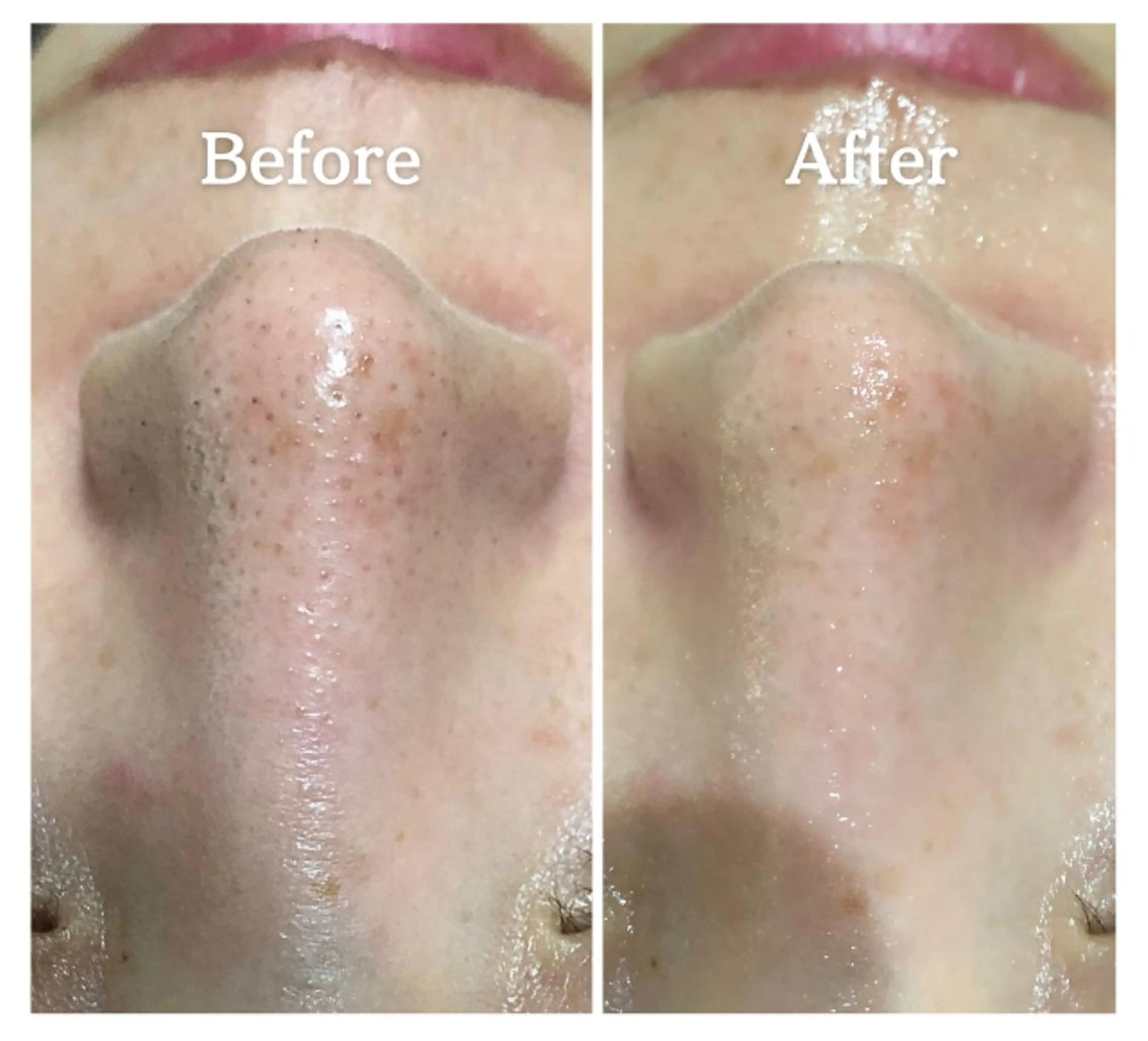 《シミ/くすみ/毛穴の開き/角栓》塗る白玉注射◆極上美白ハイドロfacialの写真