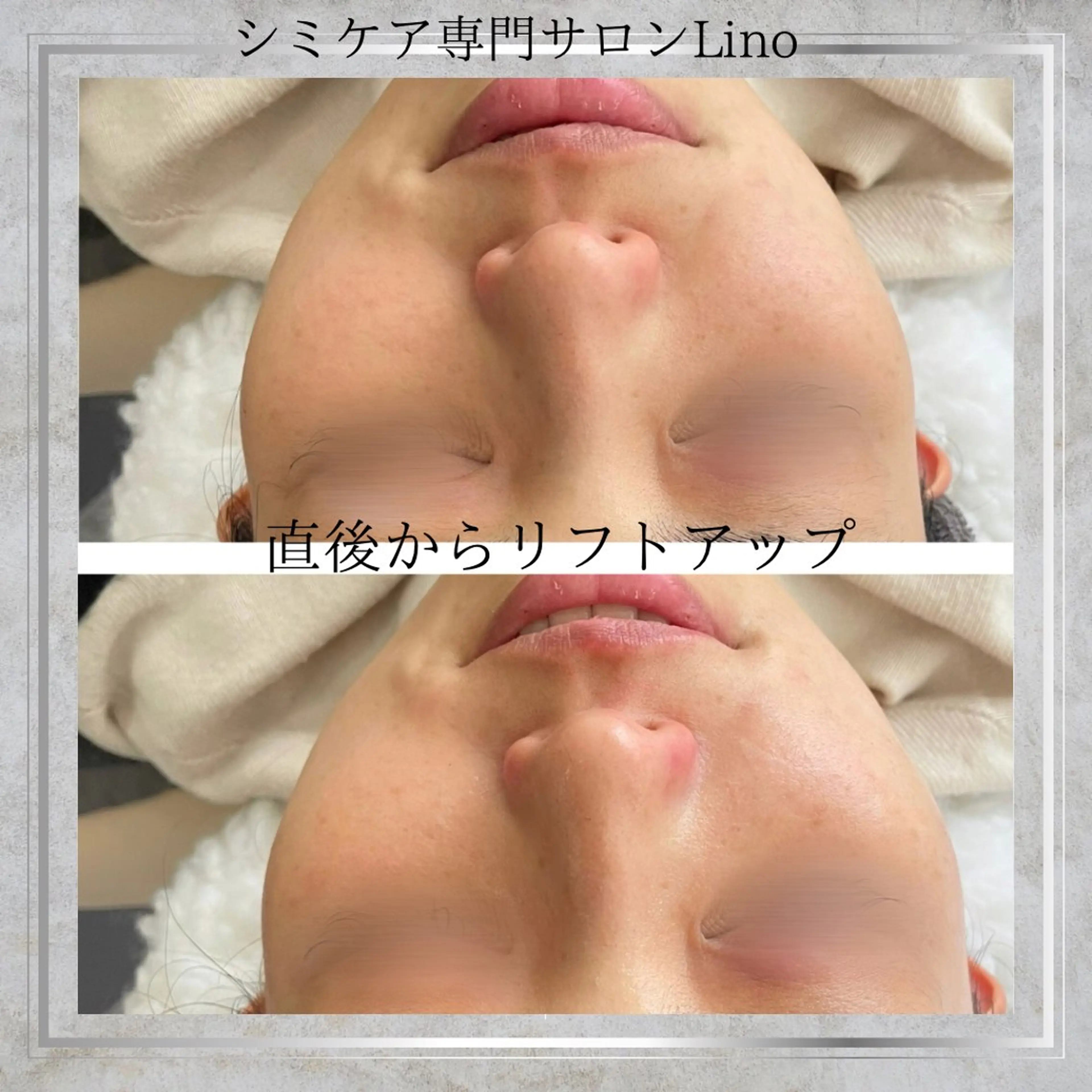 ハリツアUPならWIQ0 水光ピール！の写真