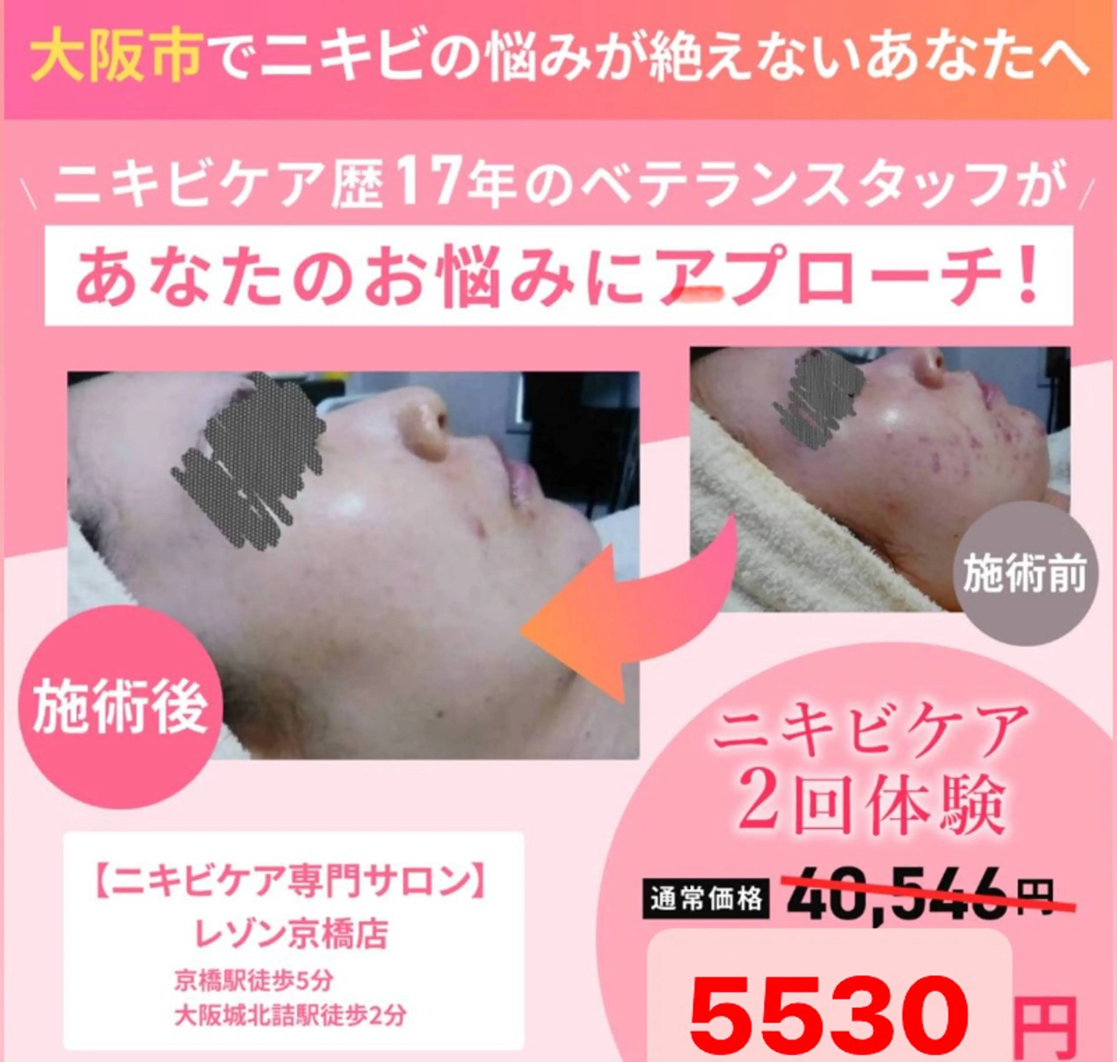 ニキビケア◇ニキビ跡 レゾン京橋店　八崎のエステ・リラクイメージ