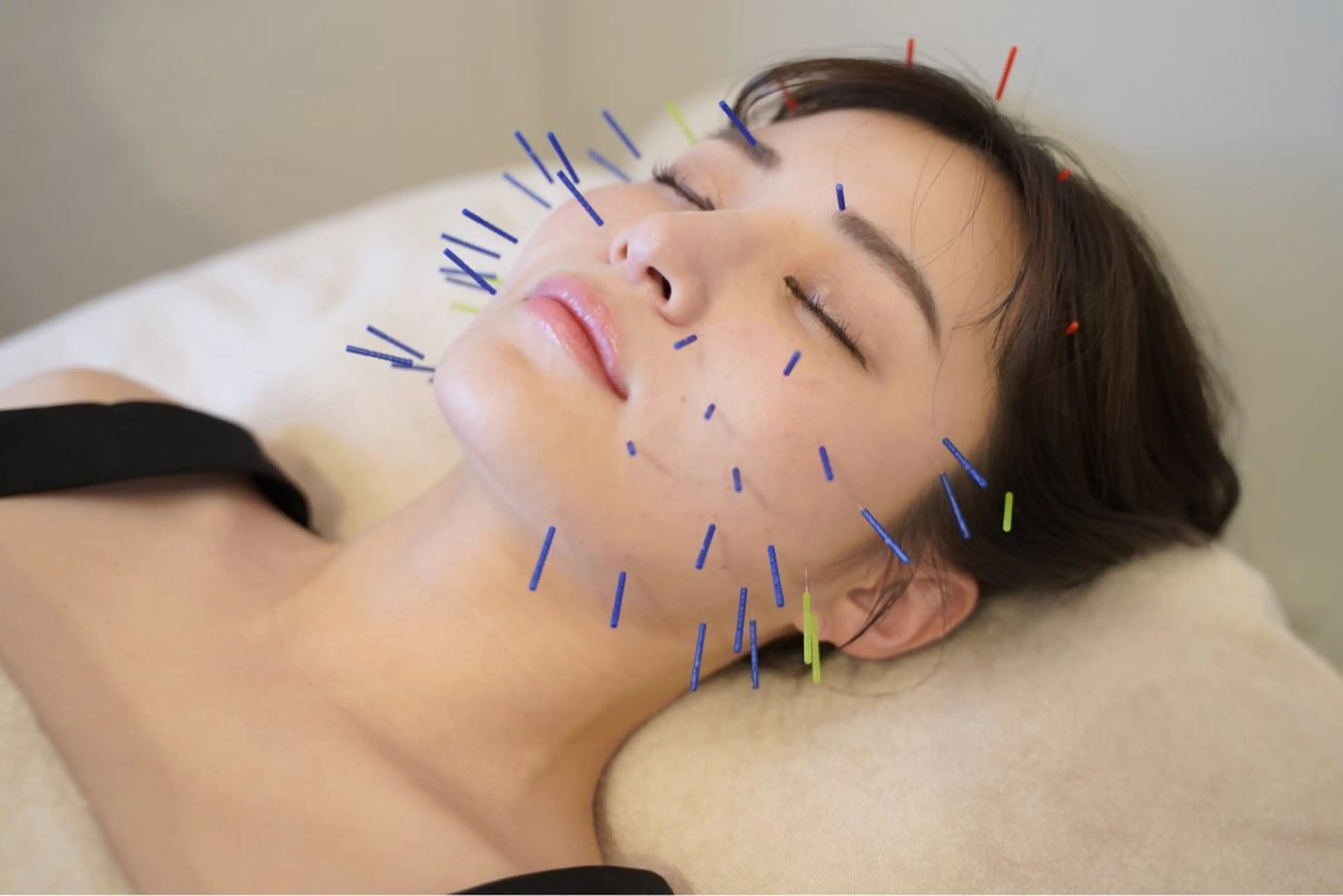 美容鍼✨小顔美容鍼🥰美容鍼+電気パルス✨3回目まで利用可能の写真