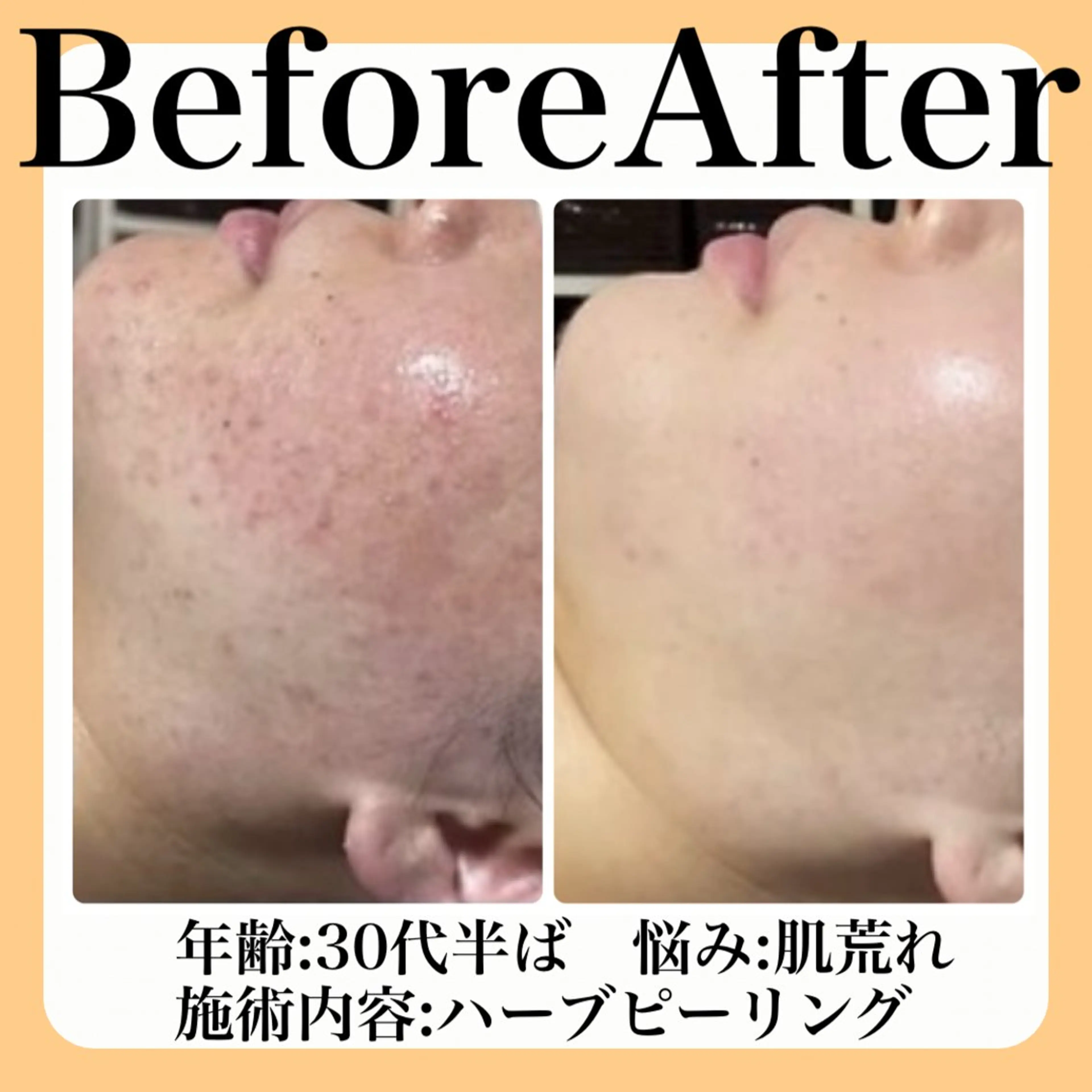 エステ 毛穴・たるみ･ニキビケア専門サロンsui所属・sui【スイ】 ARISAのエステ・リラクイメージ