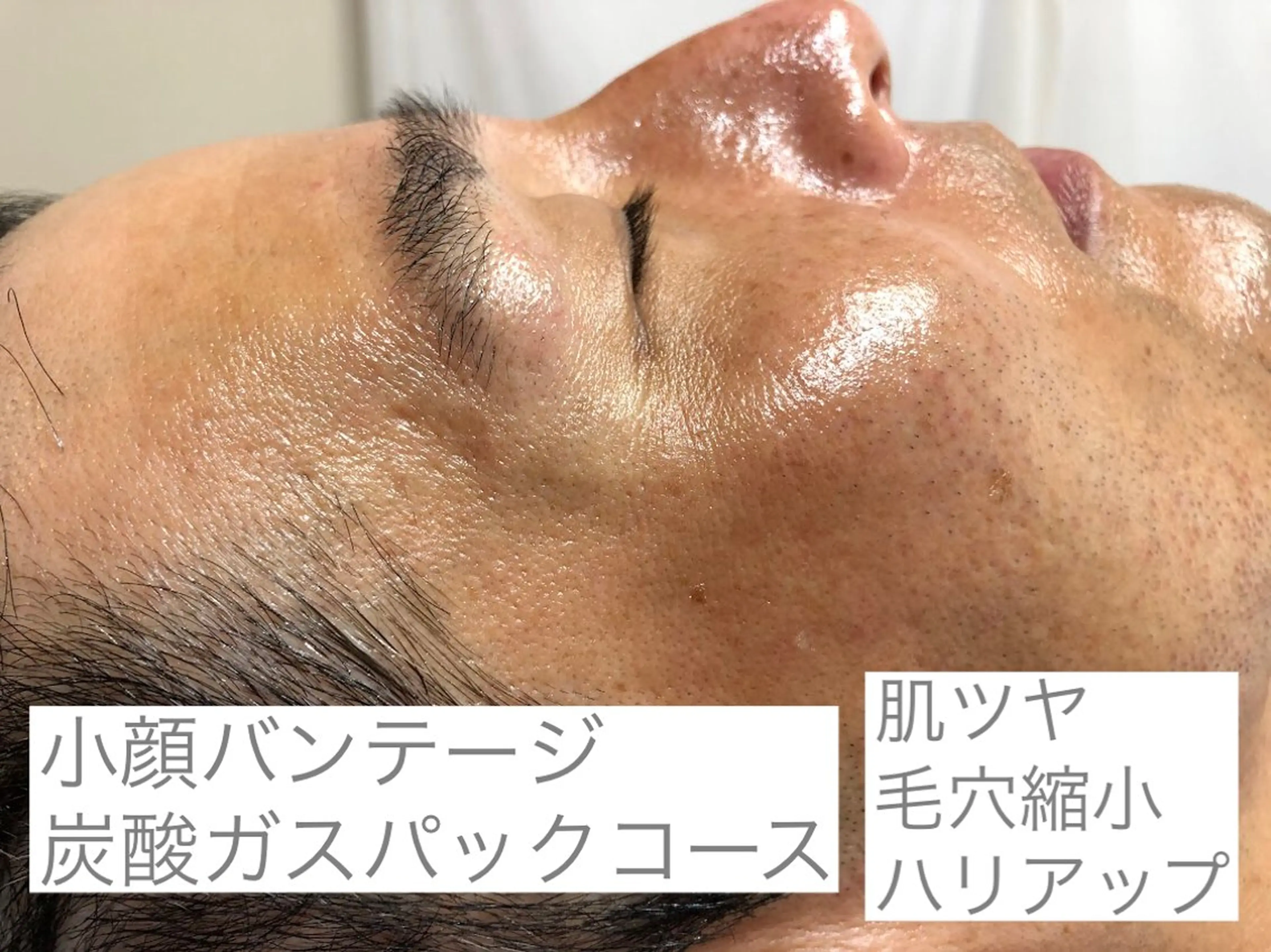 メンズも美肌ケア☆小顔バンテージ炭酸ガスパックコースの写真