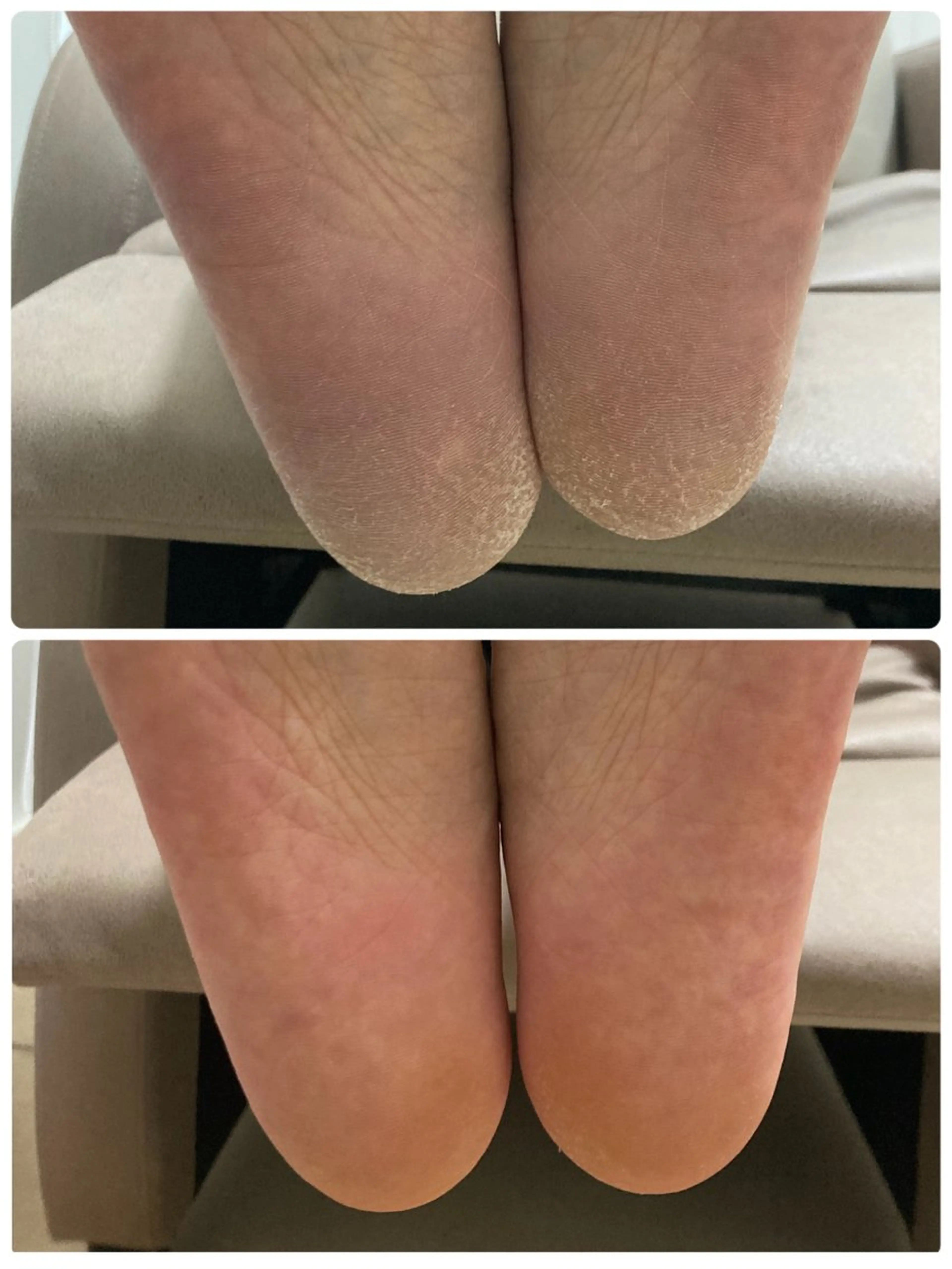 [スパルーチェ] 足裏角質除去の写真