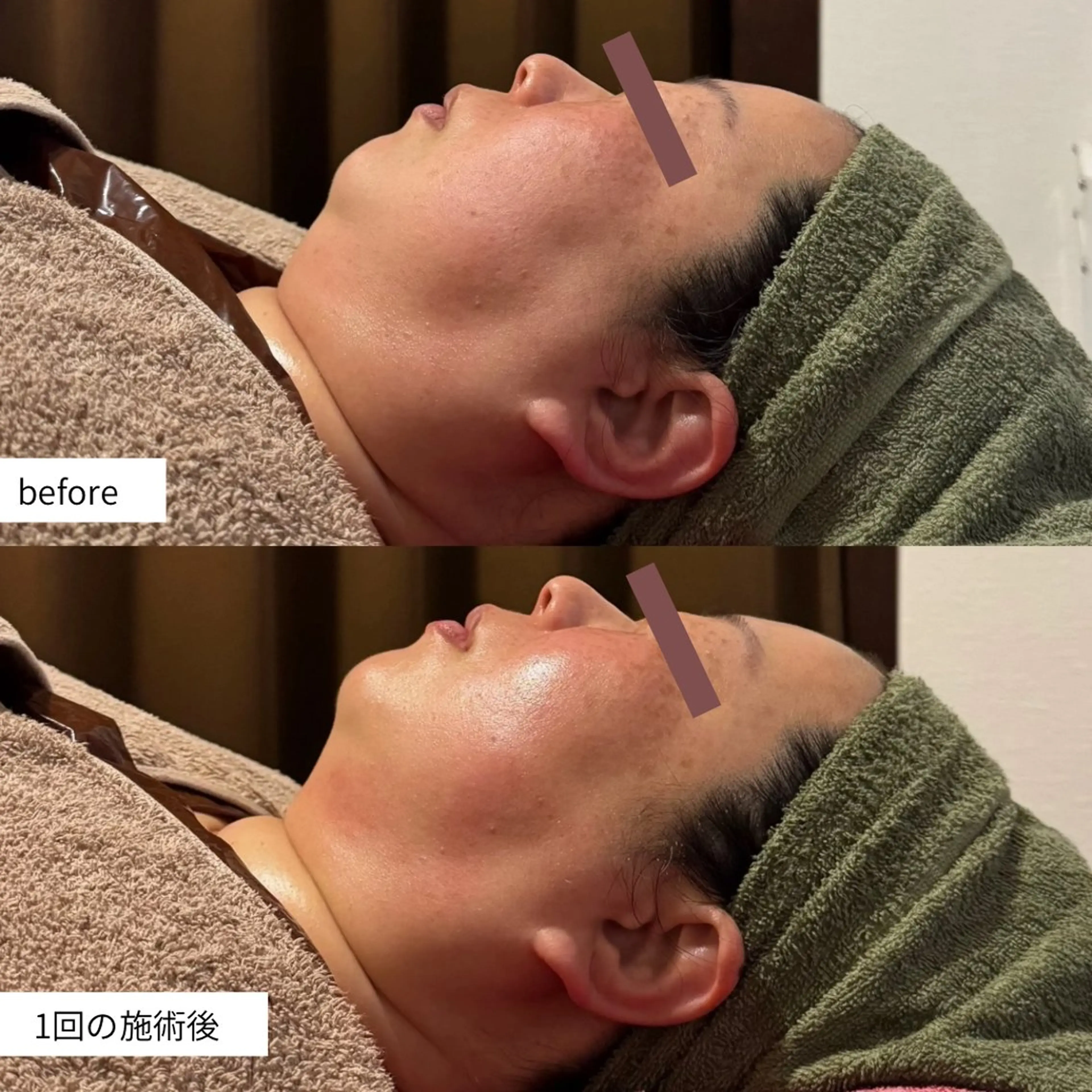 エステ シミ取り*韓国肌 エステサロン✶クロヌのエステ・リラクイメージ