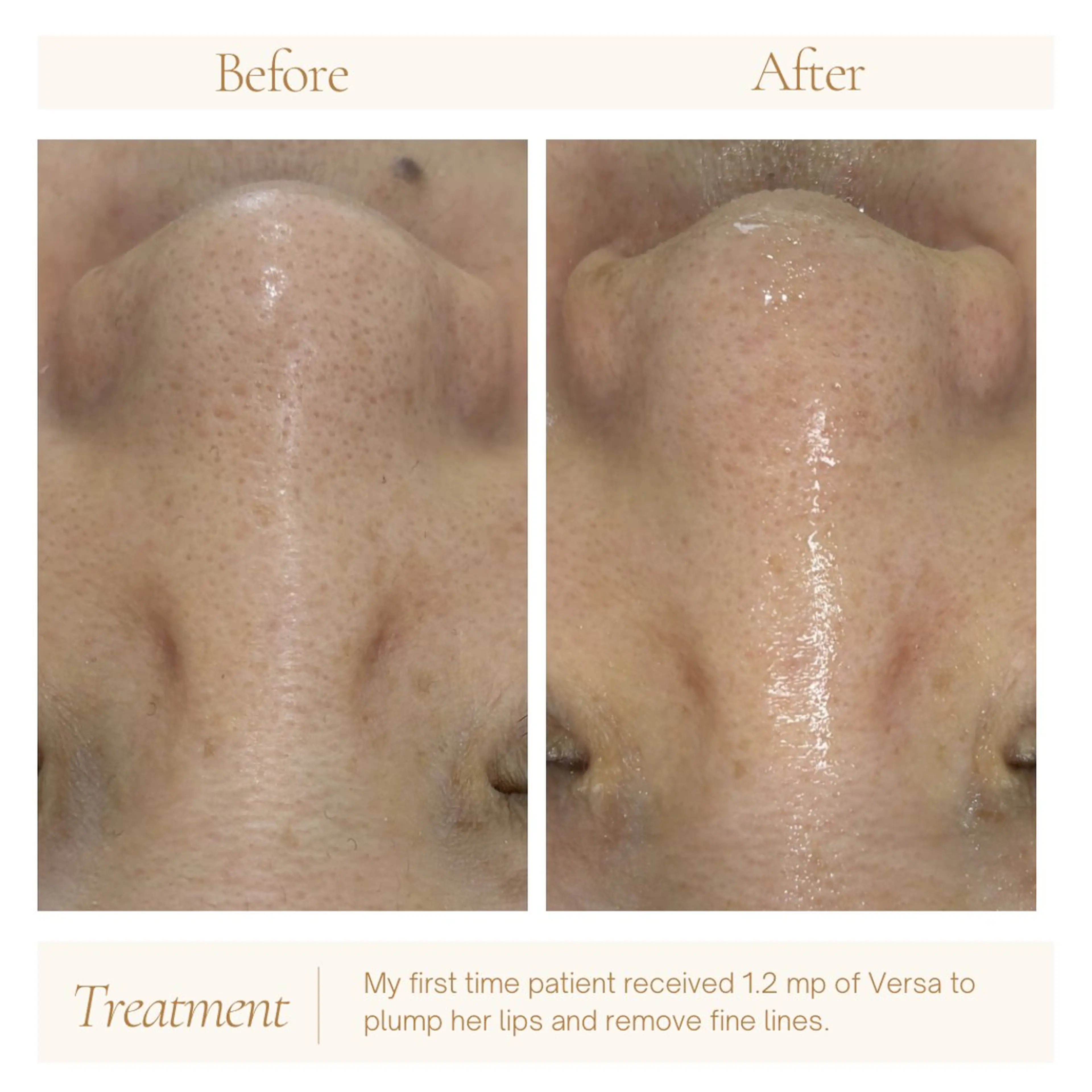 エステ AY'S所属・倉敷/玉島/20代 からの大人毛穴洗浄のエステ・リラクイメージ