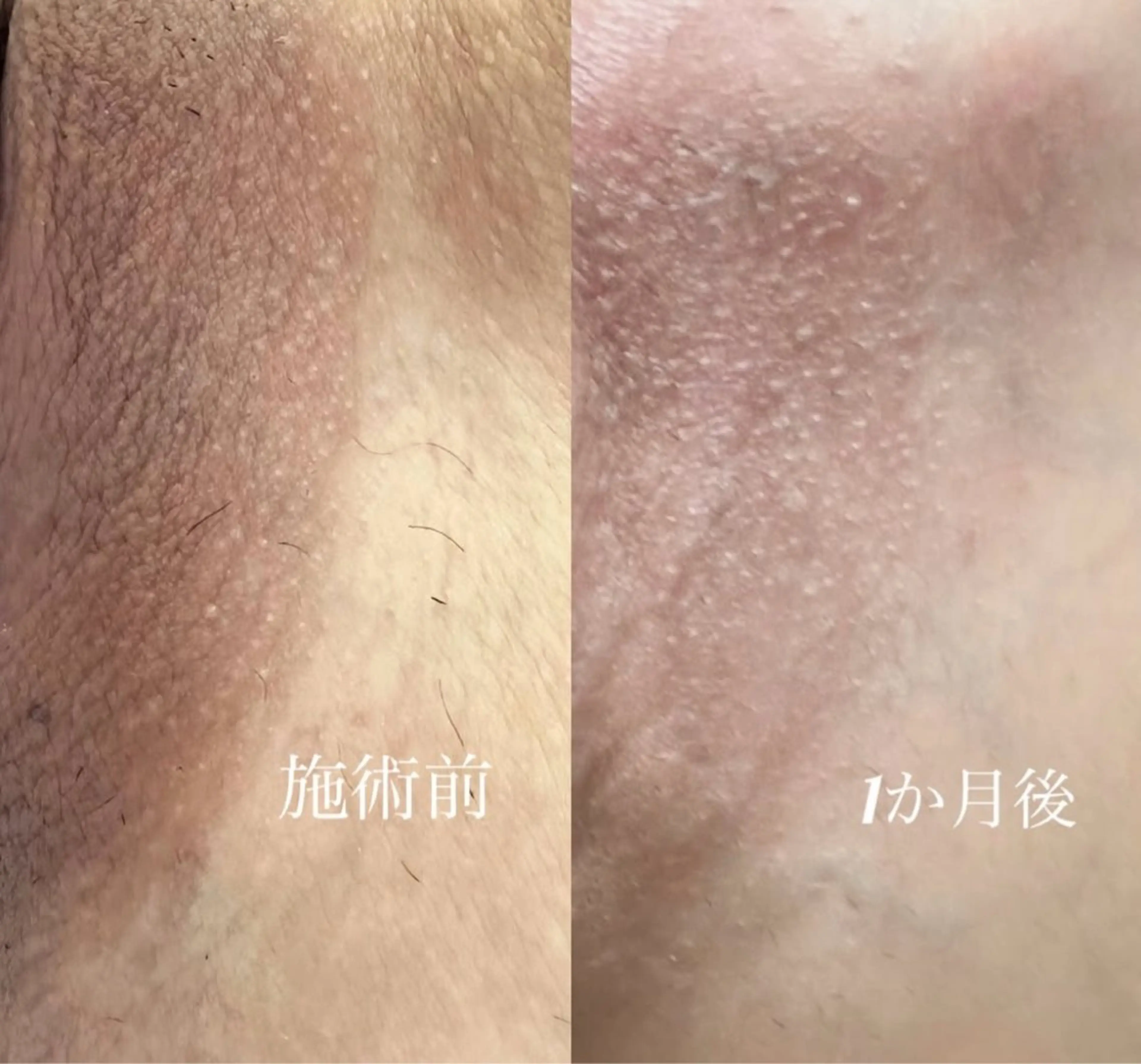 ROMA PINK 陰部 モニター定価より40%OFFの写真