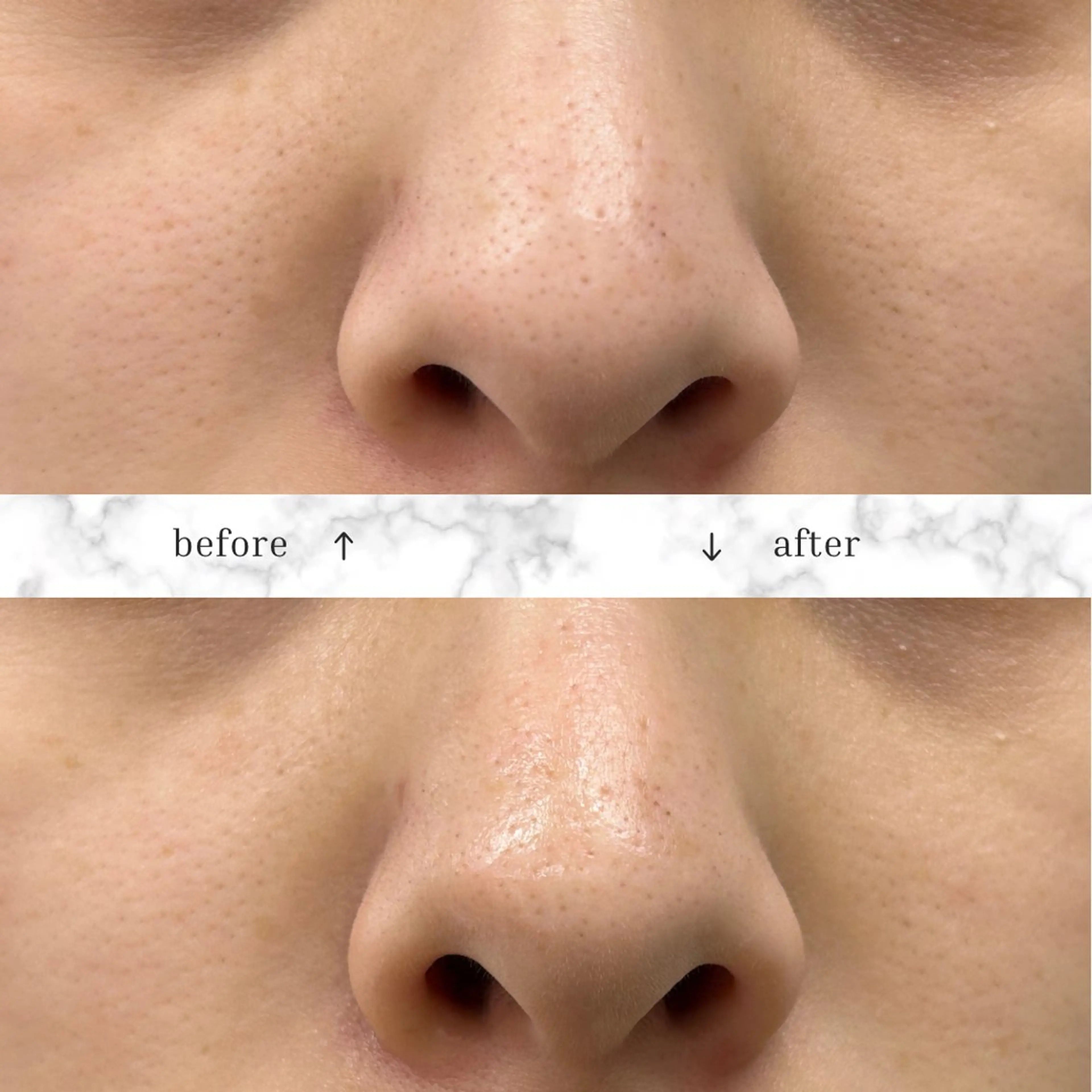 【毛穴が気になる方🙌🏻】小鼻集中エステの写真