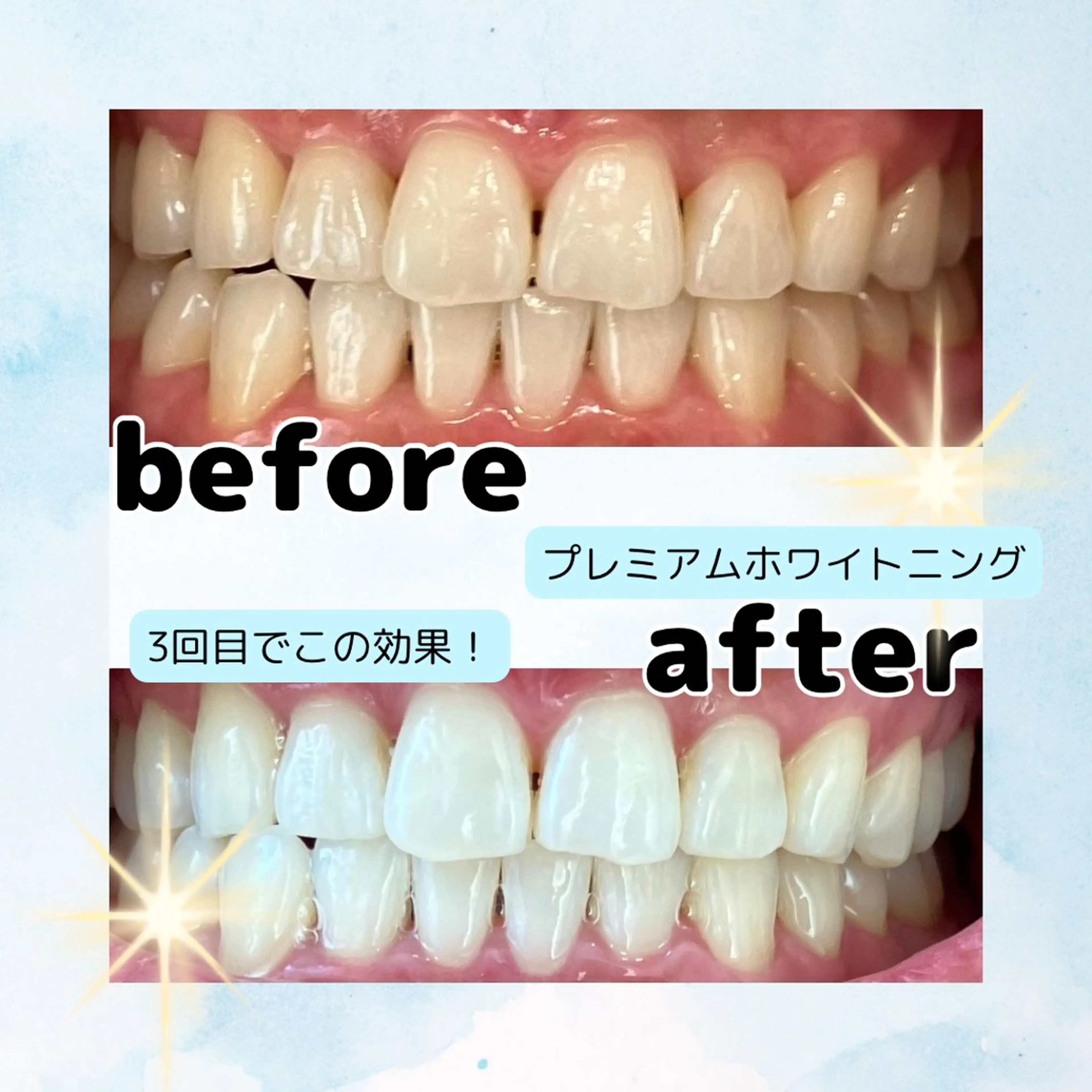 初回カウンセリング無料🦷プレミアムホワイトニング🦷ご希望のお客様はこちらの写真