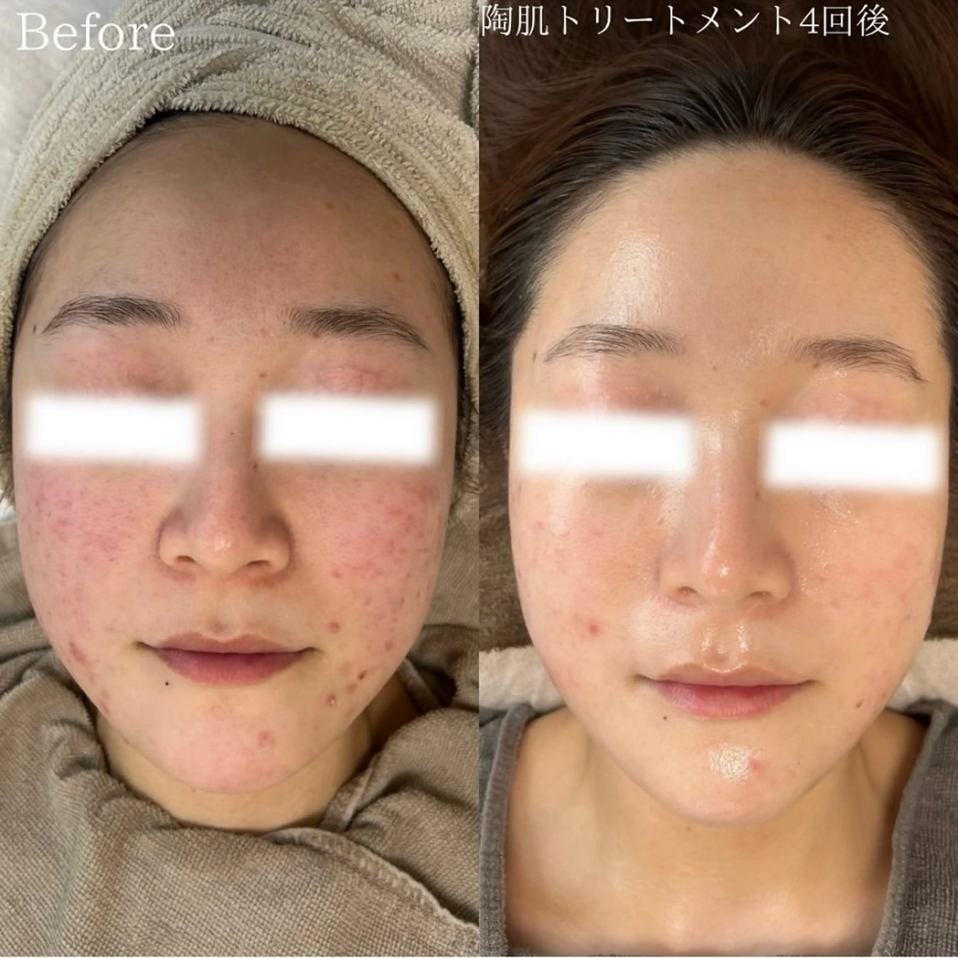 【初回お試し】ハーブピーリング/REVI陶肌トリートメント(※Before/Afterのお写真ご協力いただける方)の写真