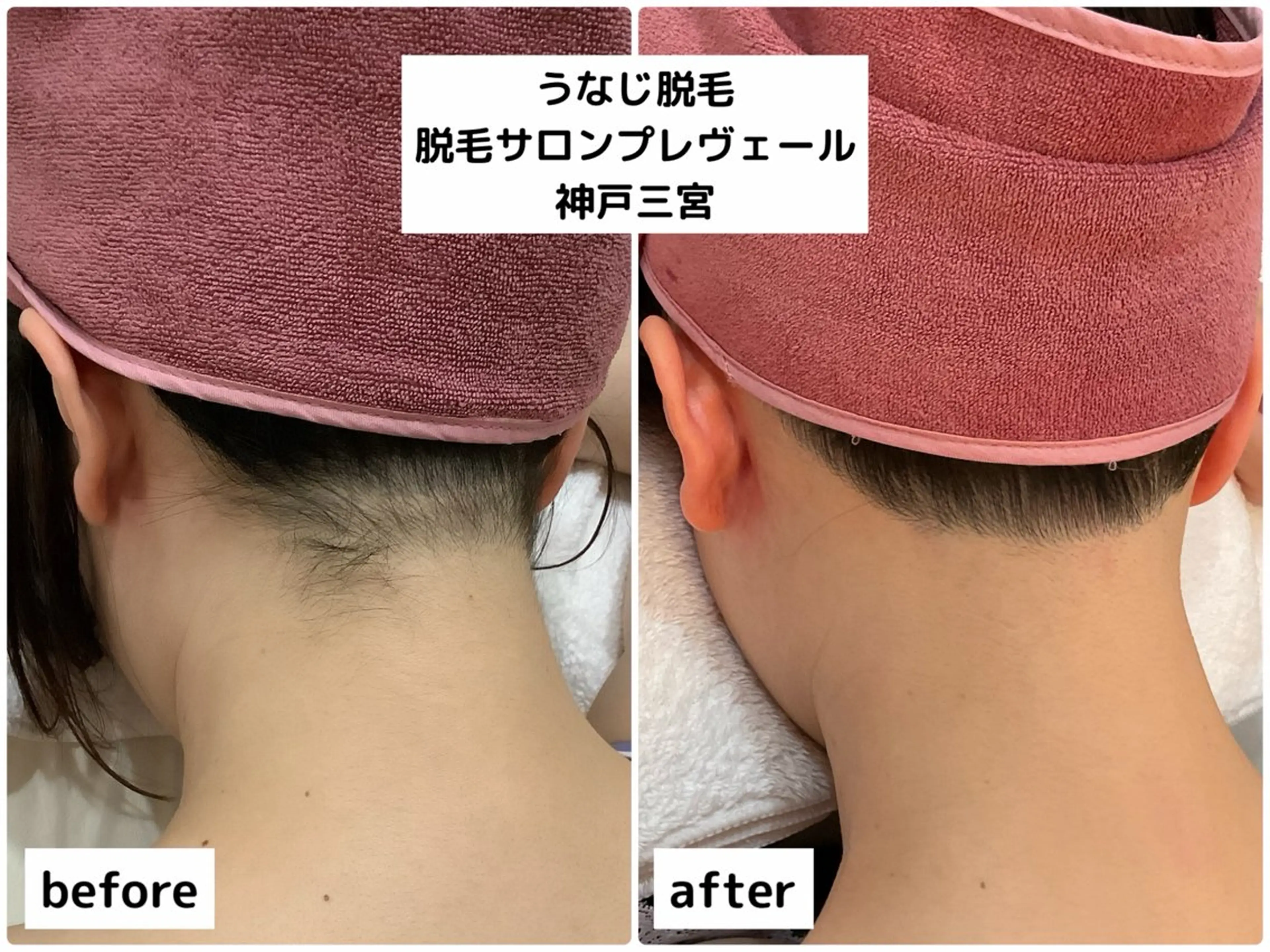 脱毛 PREVER プレヴェールのエステ・リラクイメージ