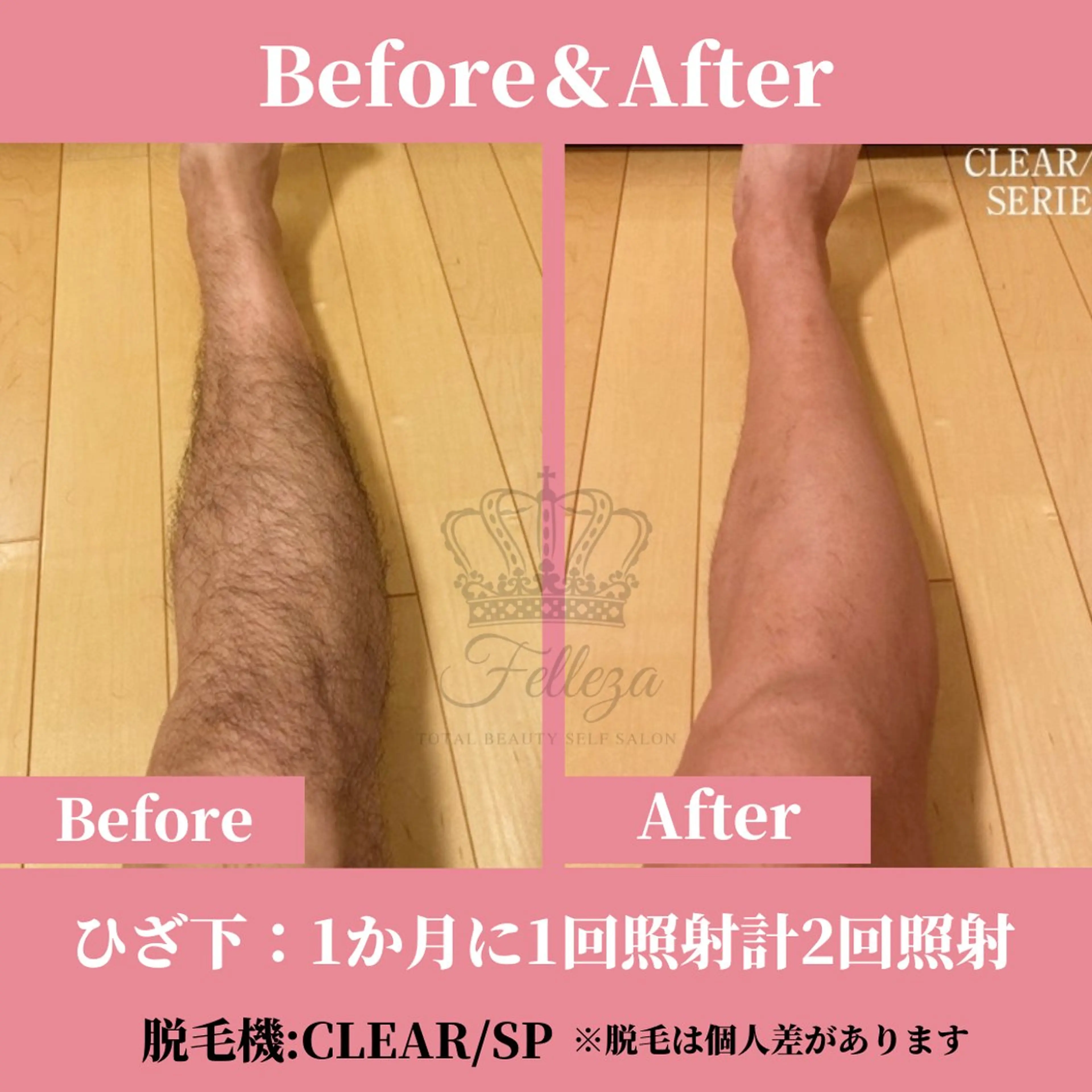 メンズ 脱毛 有人型セルフサロン 脱毛／痩身／美顔のその他イメージ