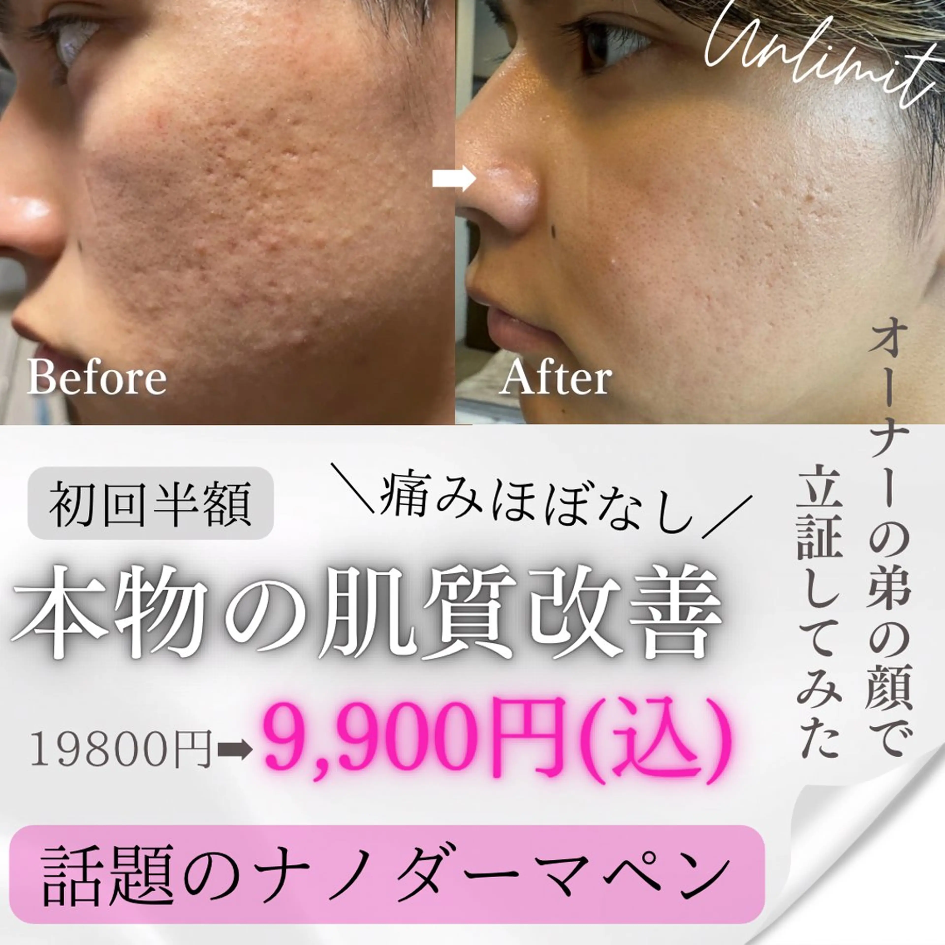 【初回/凸凹肌ケアに◎】肌質改善/毛穴洗浄×幹細胞エクソ導入×ナノダーマ約60分の写真