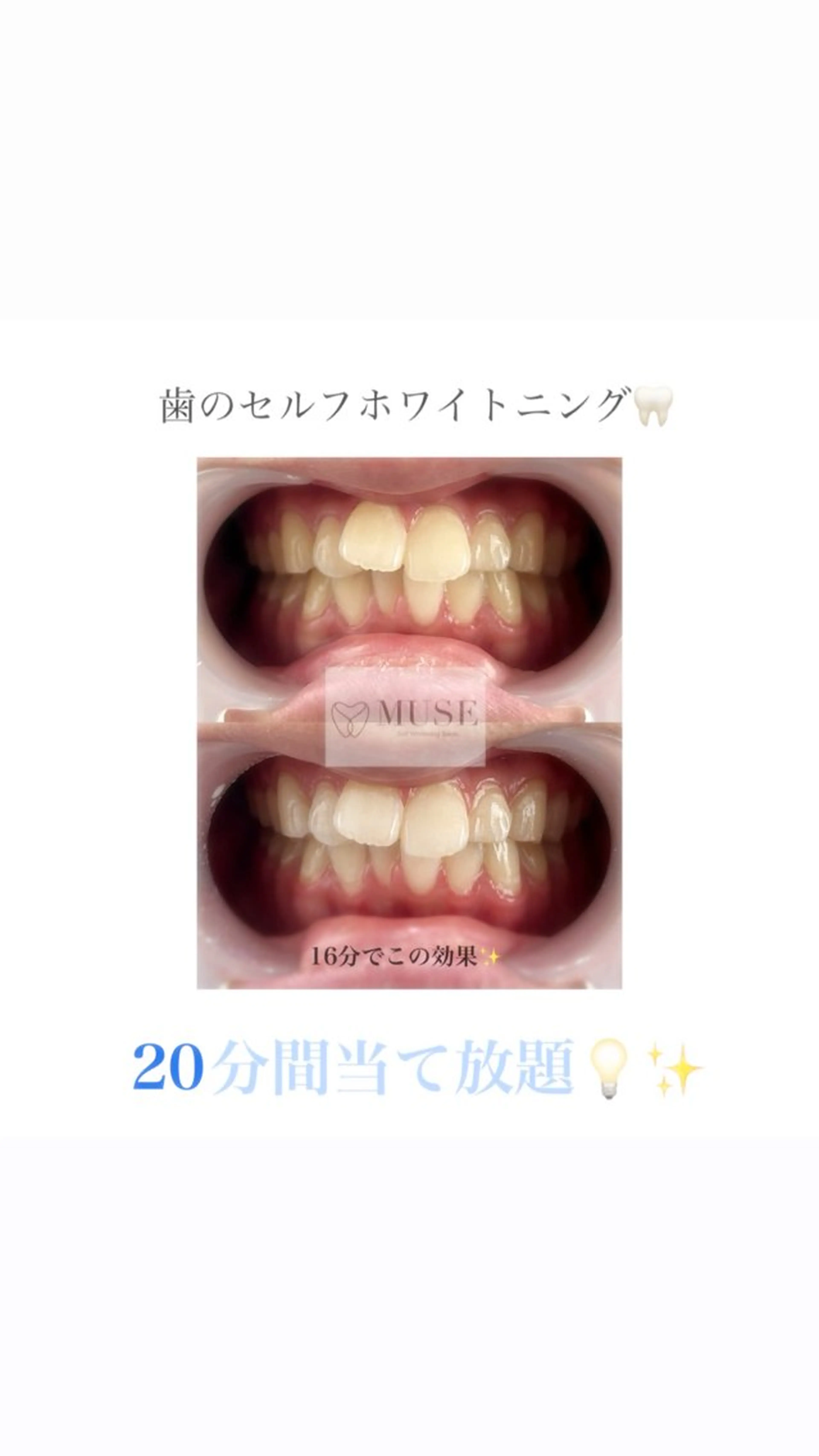 🌸2026年3月ご卒業予定の方限定🌸お試しセルフホワイトニング20分間当て放題🦷✨の写真