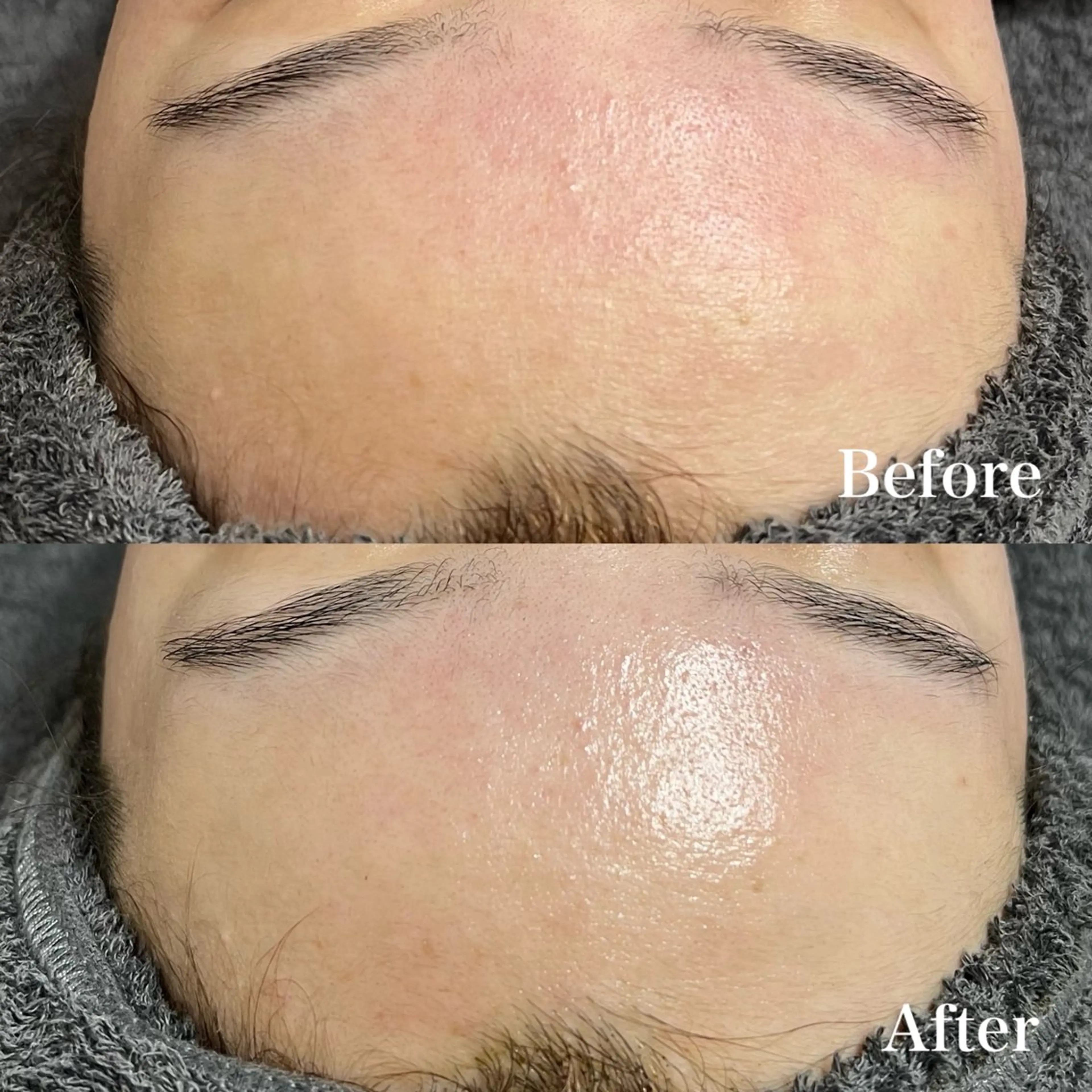 🍋【ニキビ毛穴シミに】REVIハーブピーリング《陶肌トリートメント》➕VCFリキッド 0.8mlの写真