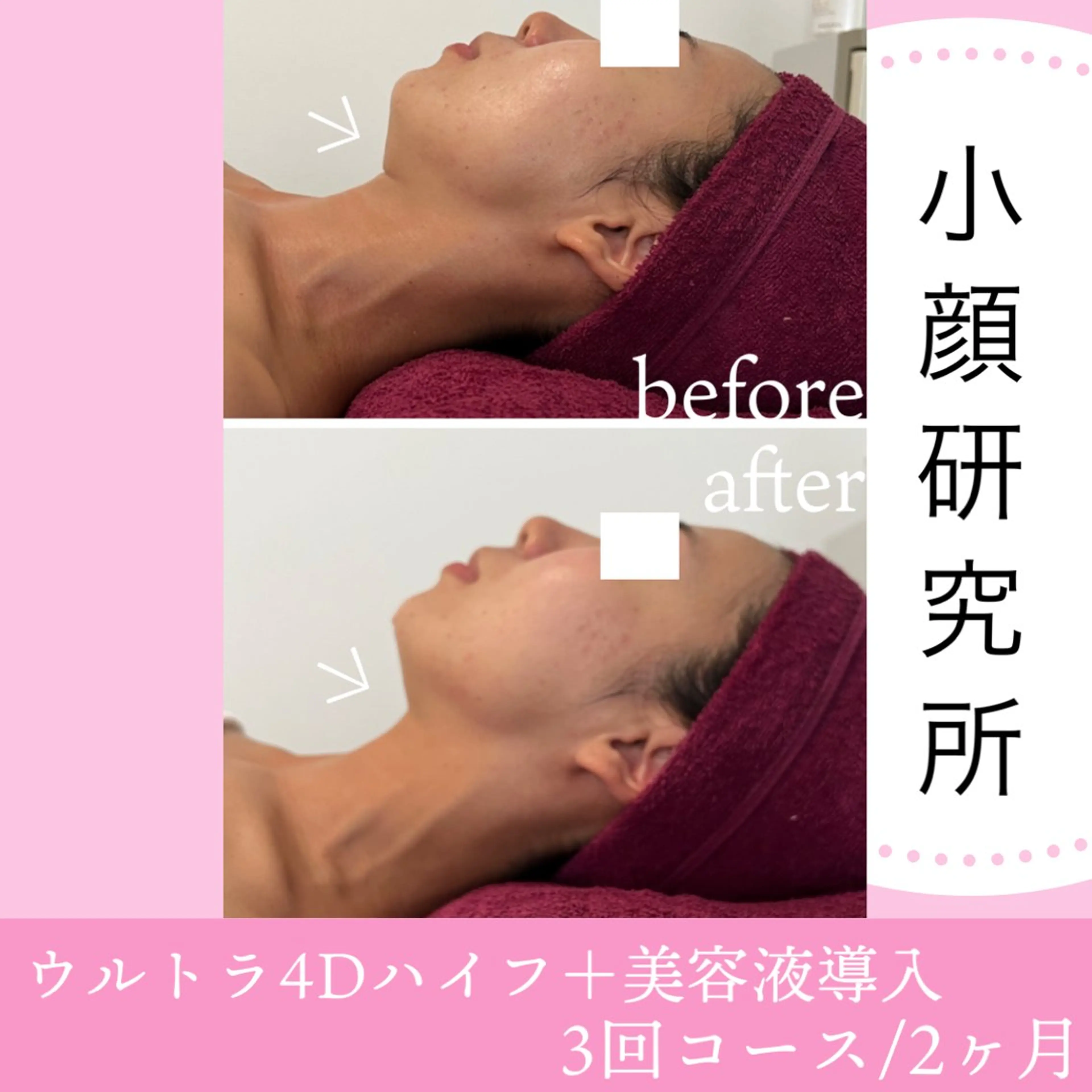 ✨1月限定◆EMS小顔マシーン体験！即日小顔！ 8,000→4,500の写真