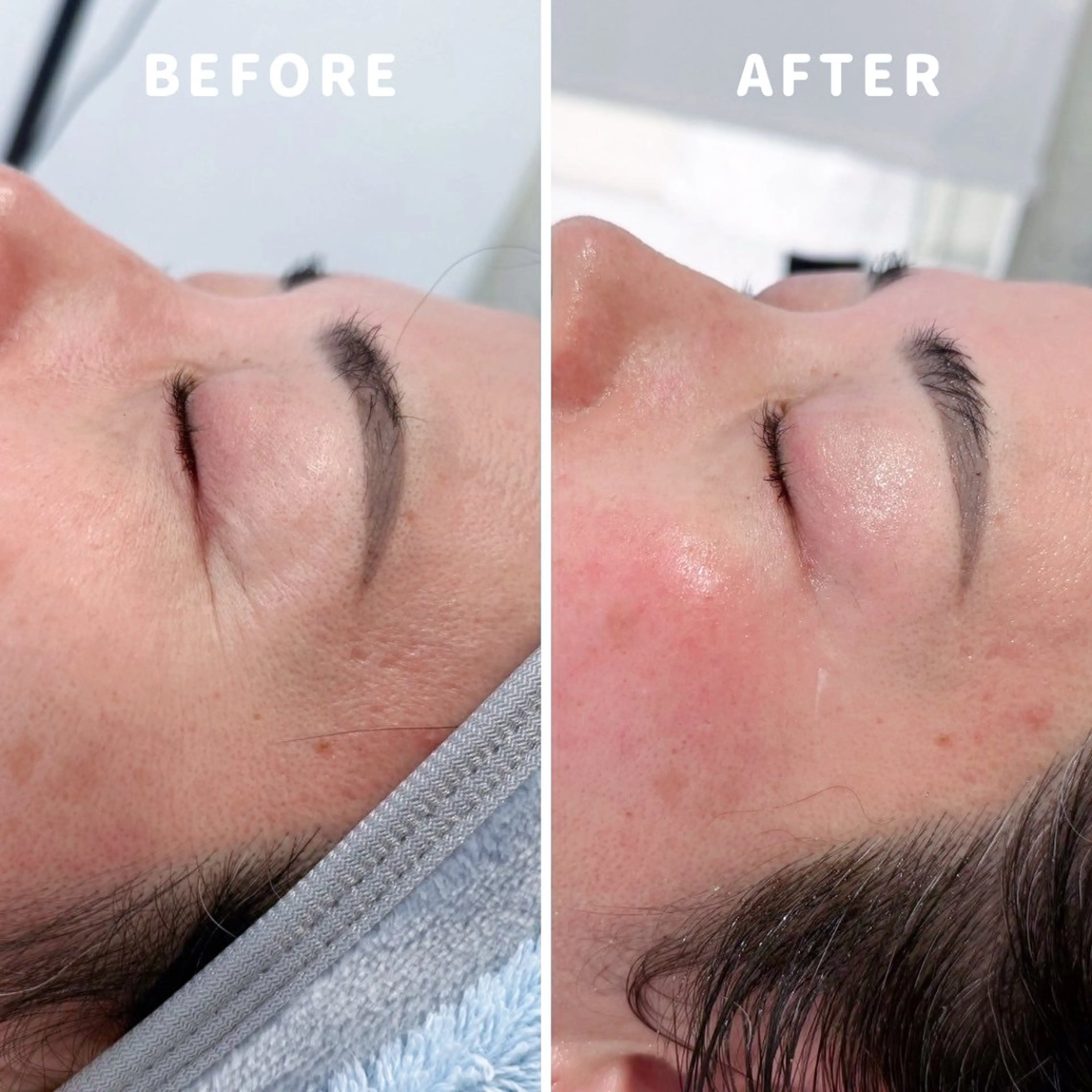 【贅沢プラン】話題の肌育成ハーブピーリング［全顔(アフターケアフェイシャル付)］🌿一回でも効果実感✨※合計2回のご来店の写真