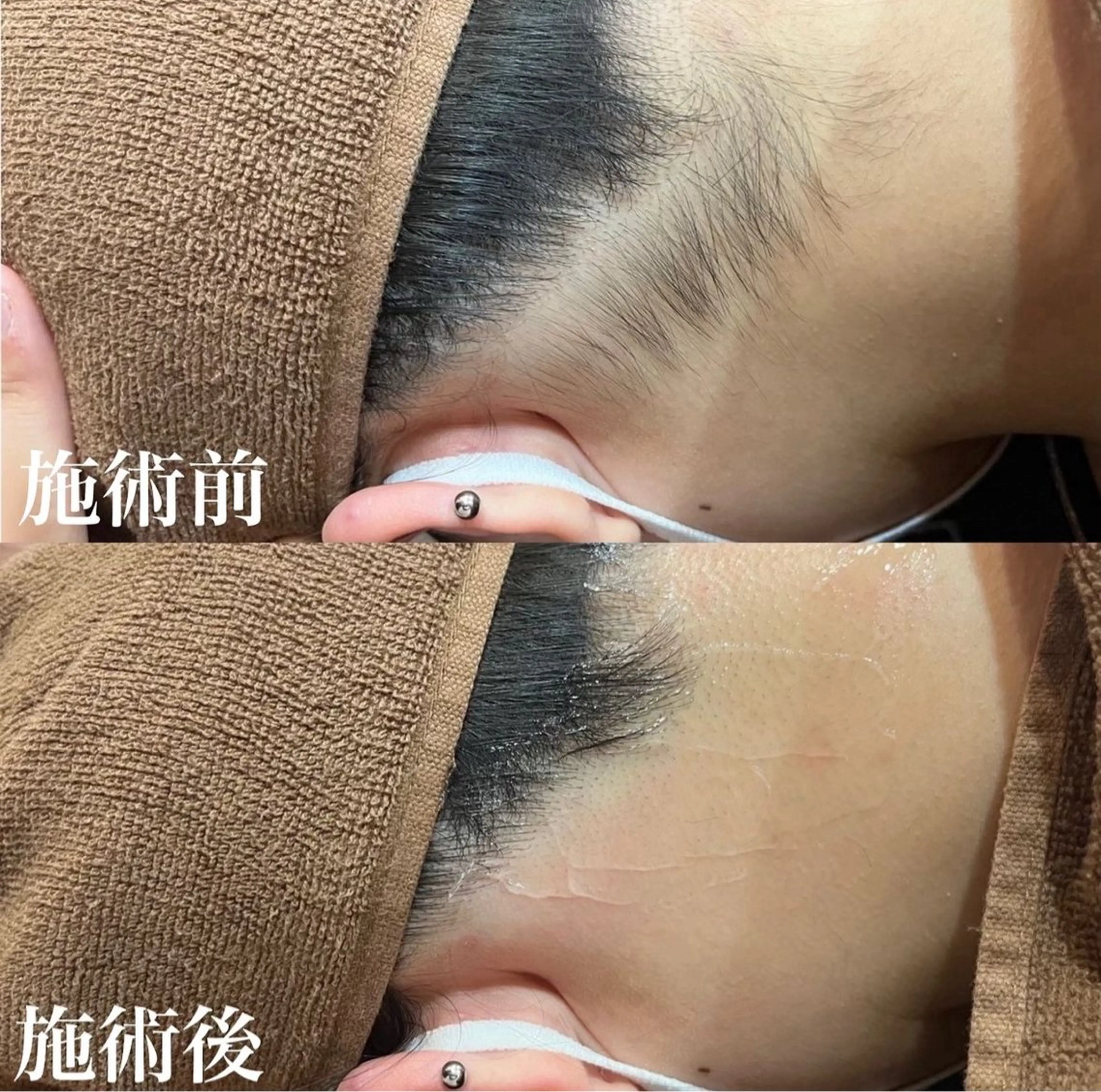 【シェービングのみ】うなじ・背中全面シェービング、プラセンタ保湿付き🤍の写真