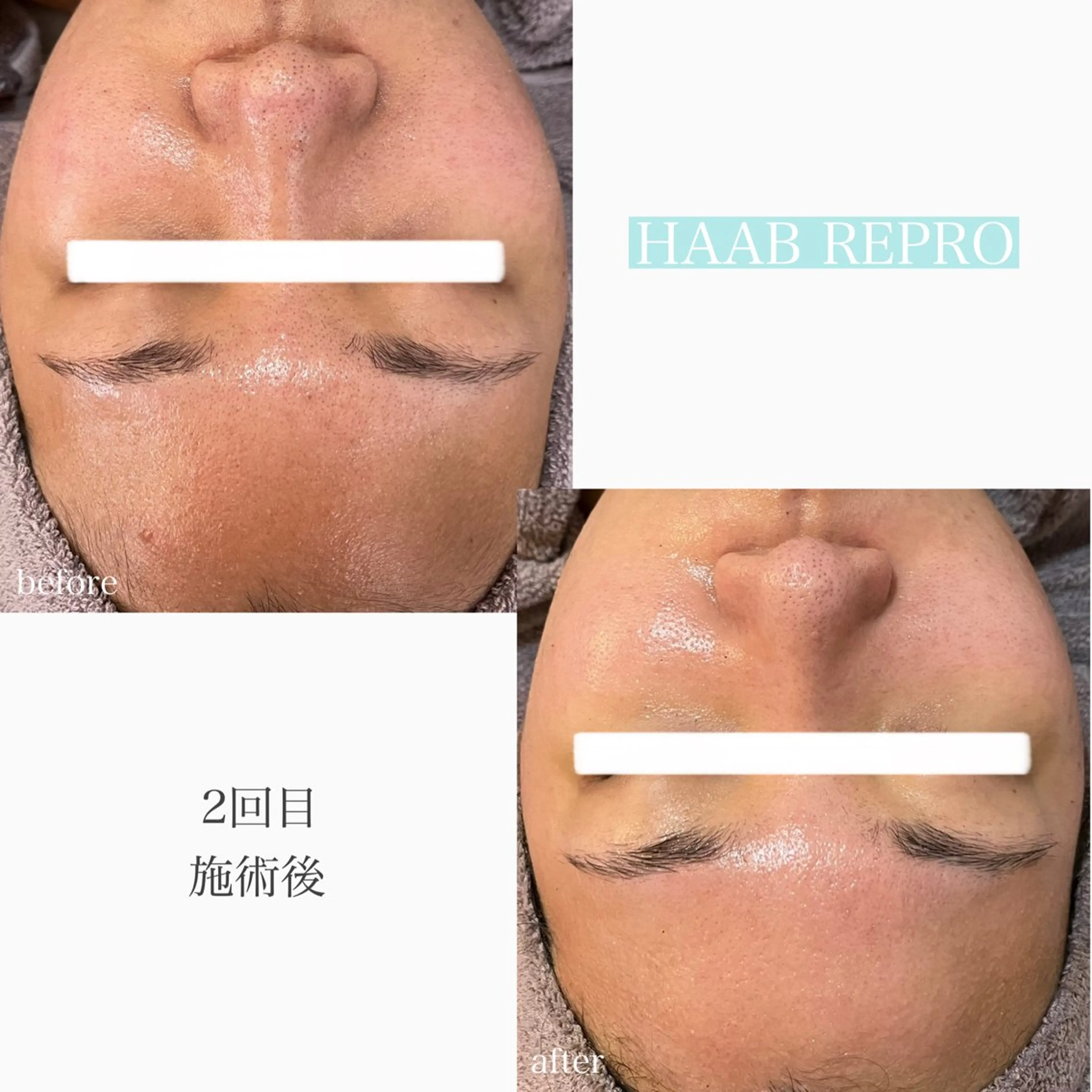 1ヶ月後も半分残る 高持続LEDエクステのマツエク・マツパデザイン