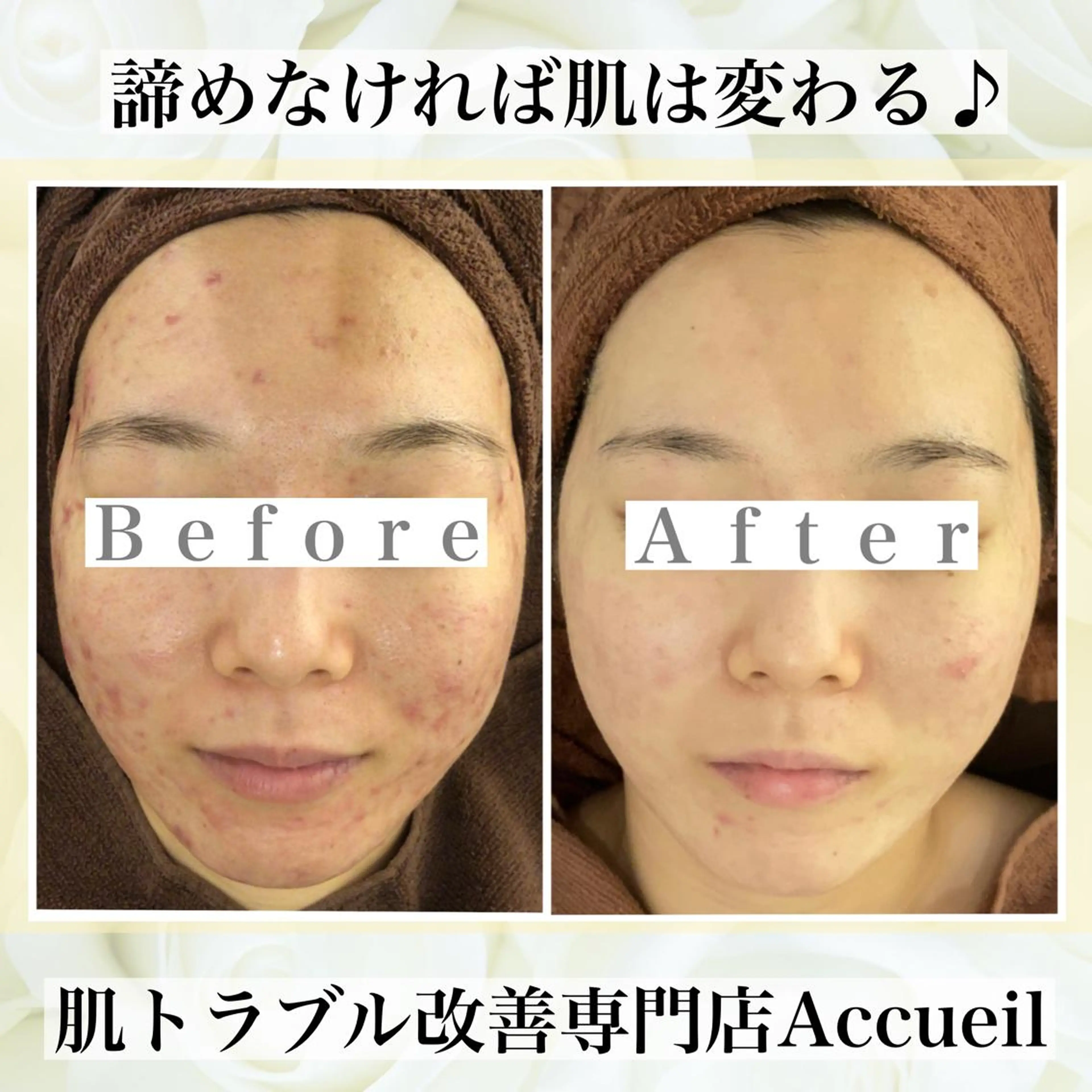 ミディアム カラー パーマ ヘアアレンジ メンズ キッズ ネイル マツエク・マツパ エステ リラク ニキビ・肌質改善専門 ♡人生が変わるサロンのエステ・リラクイメージ