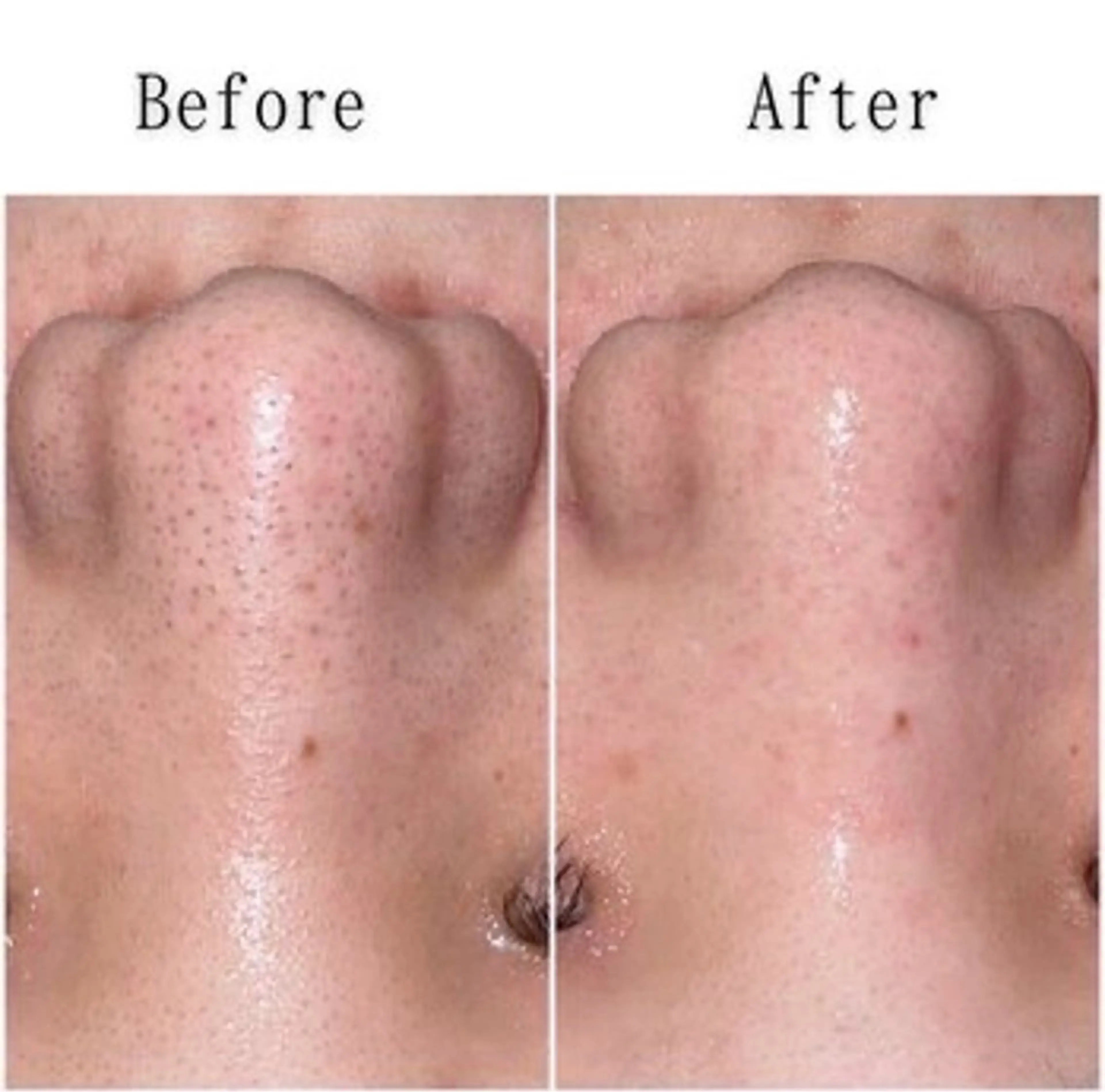 【🎀初回限定🎀】ハイドロ毛穴洗浄✨️黒ずみ除去＆つるん肌体験の写真