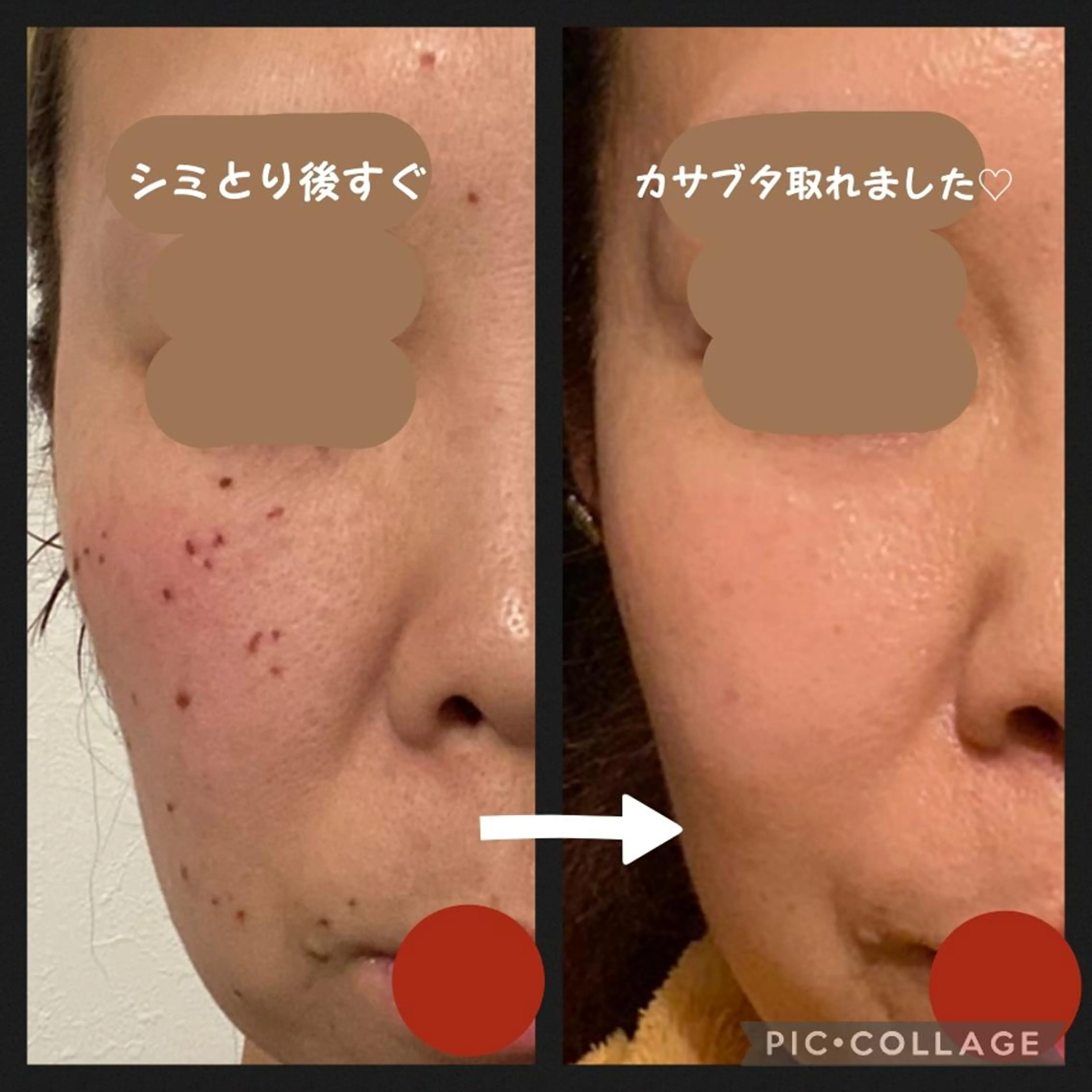 シミケア☆シミ取り放題の写真