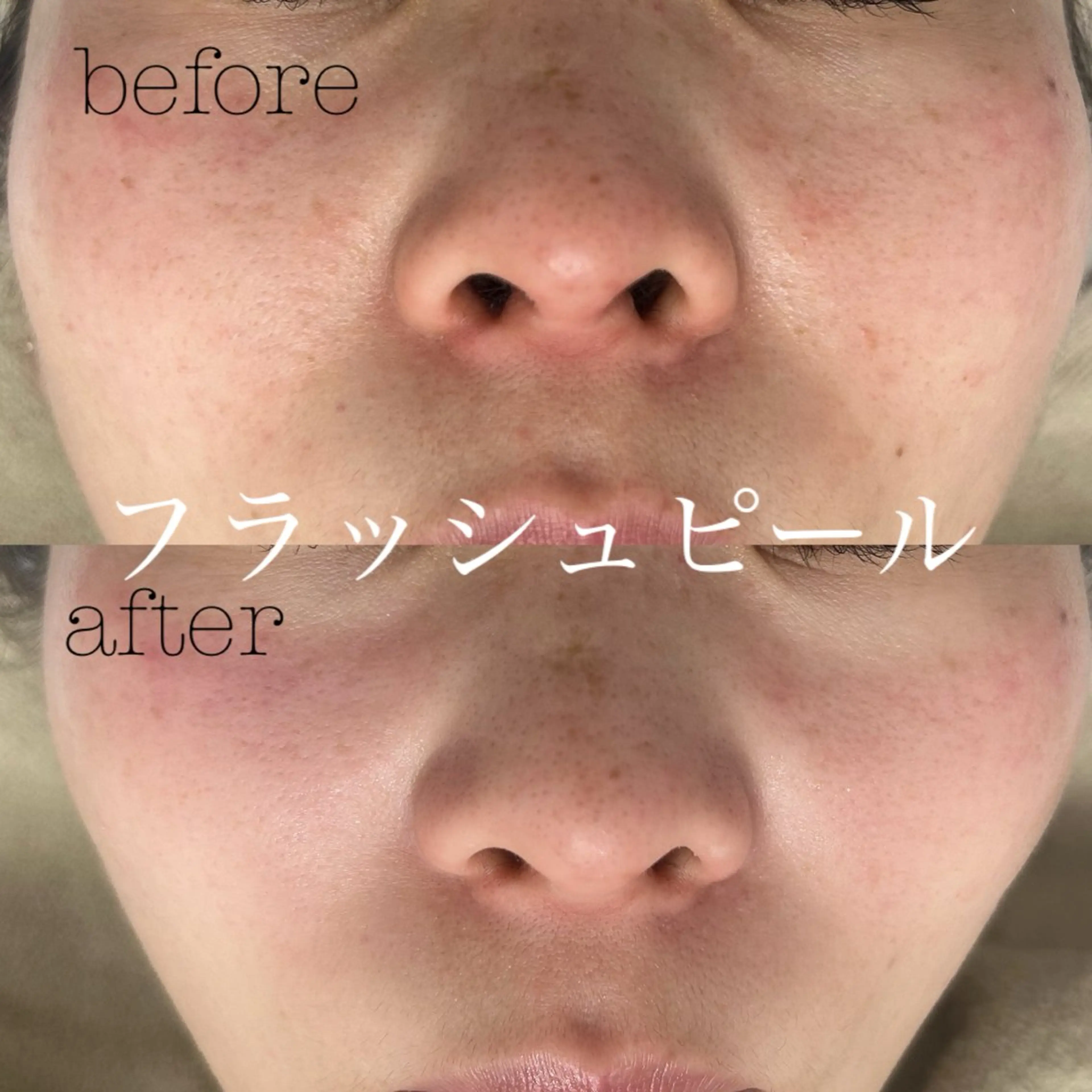 【💞リピーター様💞】フラッシュピール✨の写真