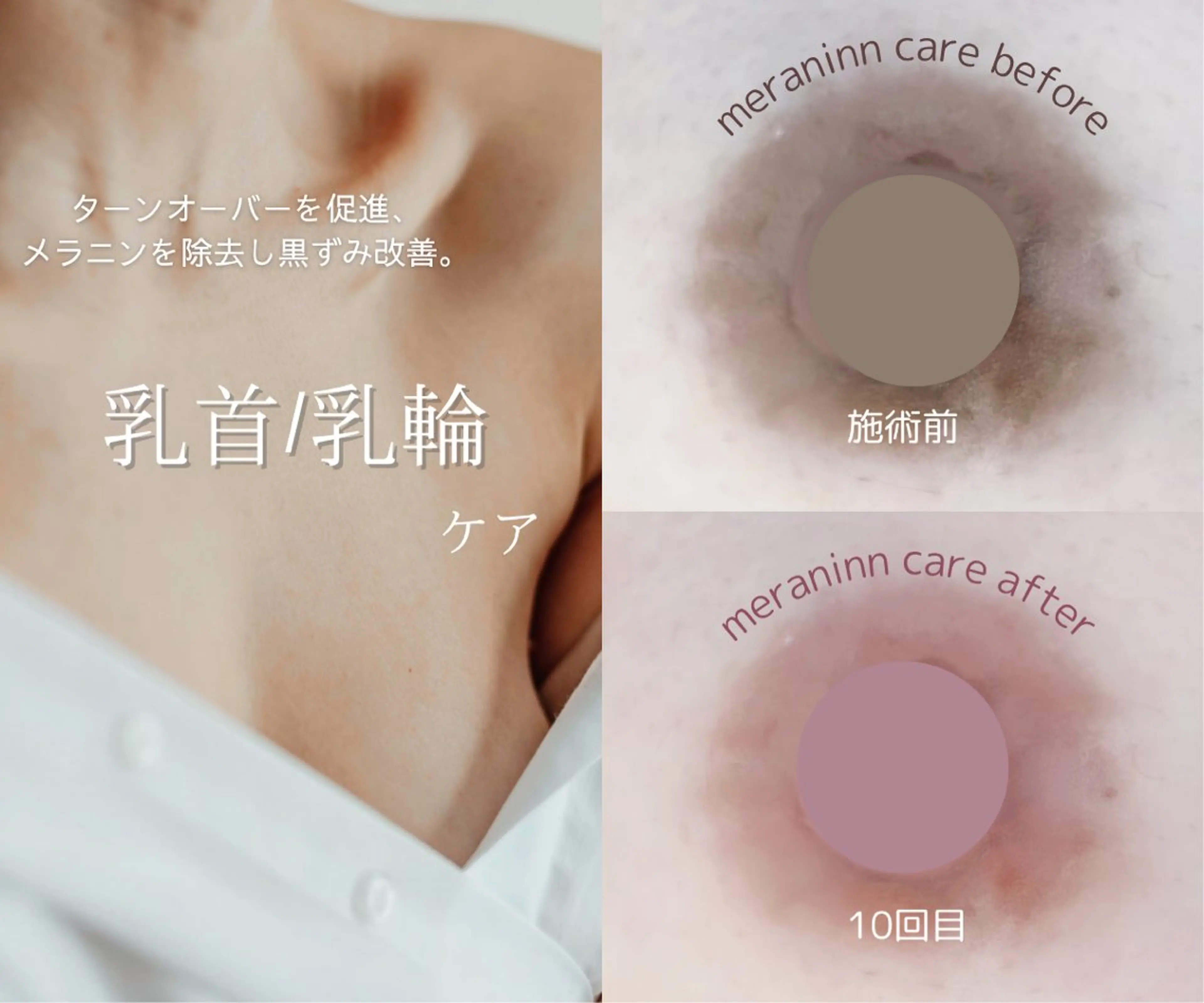 メラニン除去【バストトップ】の写真