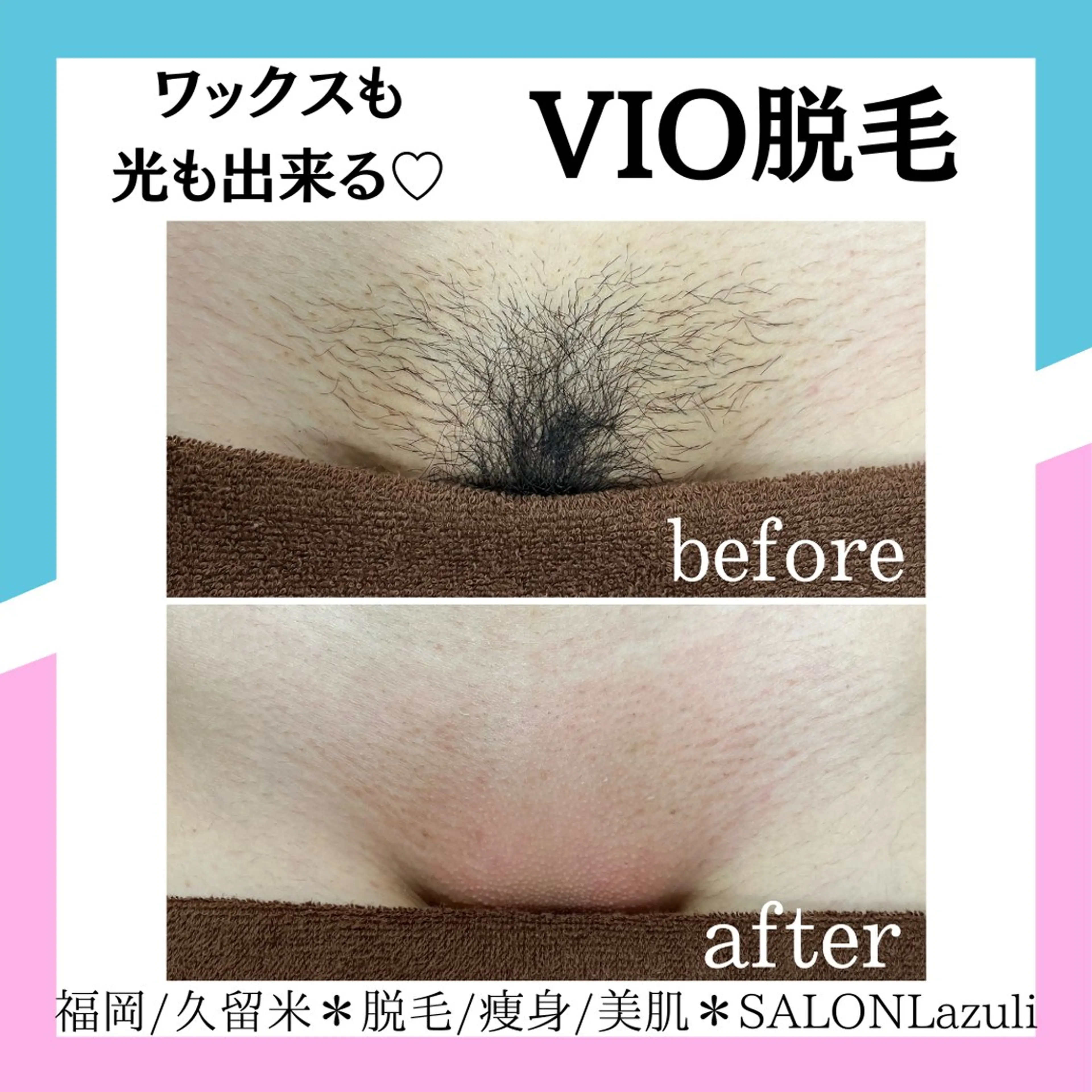 【都度払い/女性】ムレ痒み改善◎ブラジリアンワックス＋光*VIOミックス脱毛　￥13200の写真